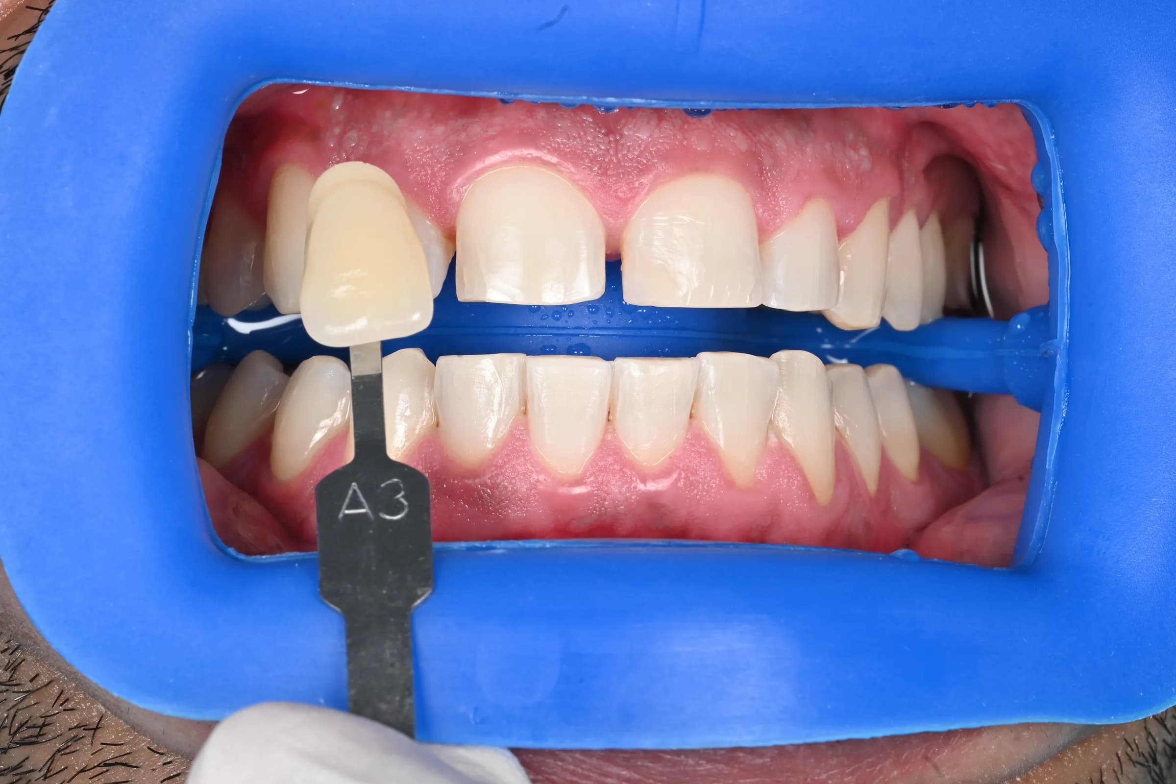 Whitening across both arches, shade matched — Shade recorded at the start — after treatment