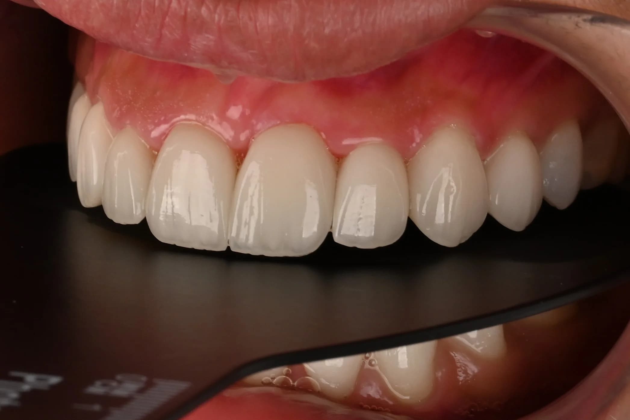 Veneers designed around the existing smile — after treatment