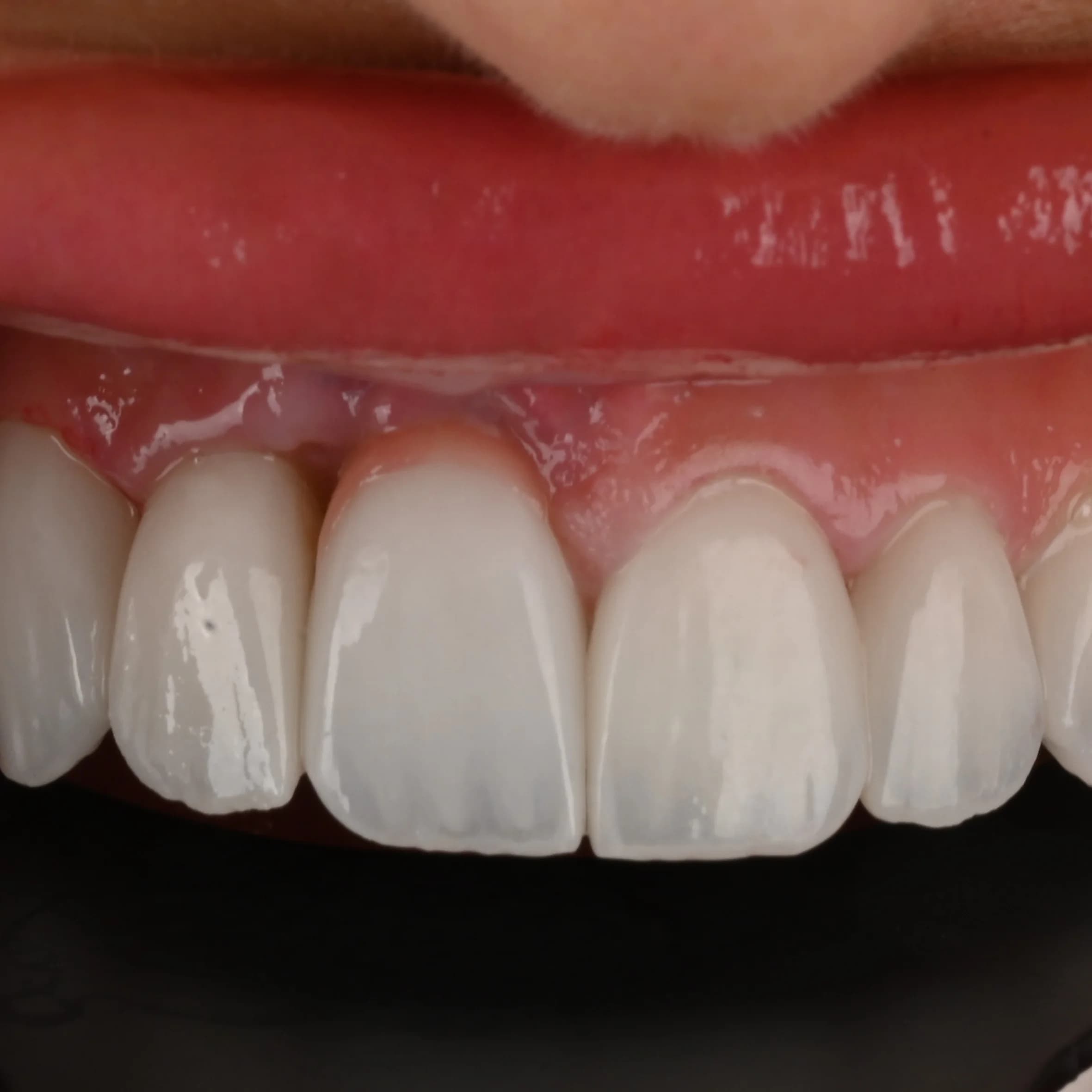Veneers documented across five views — photo 5