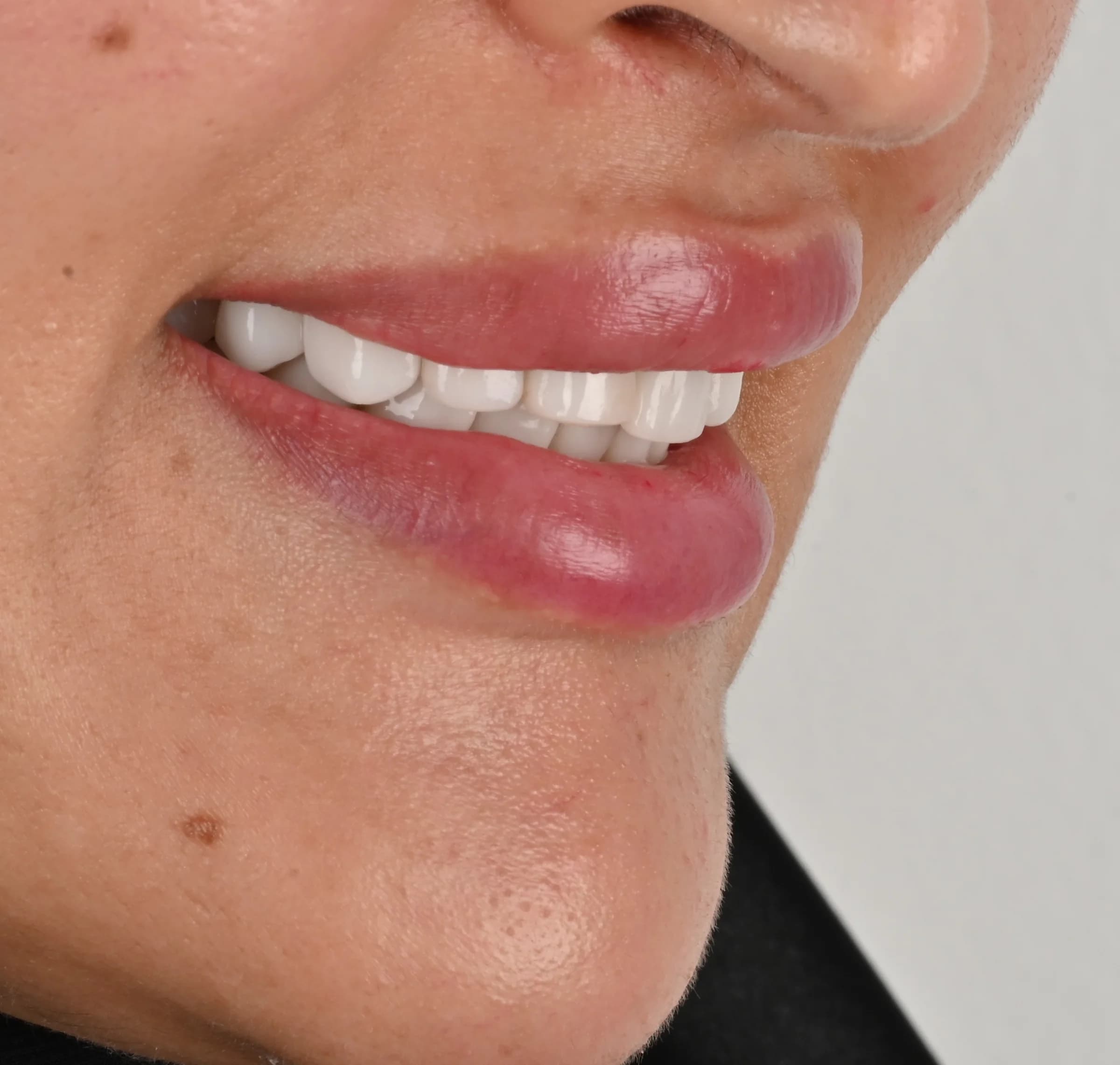 Veneers documented across five views — before treatment