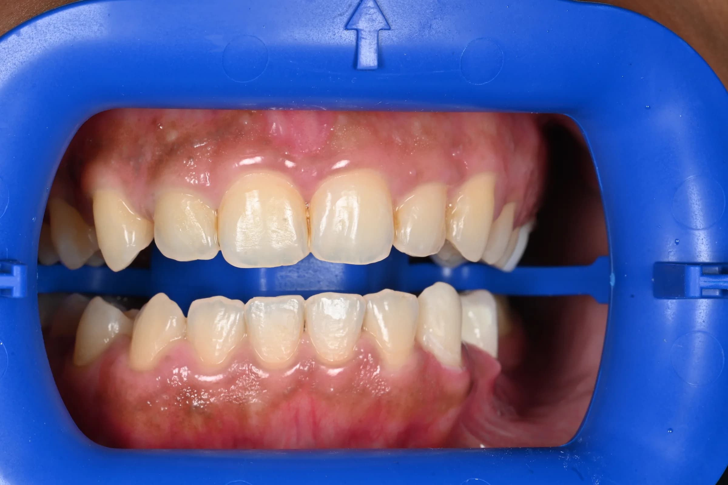 Professional teeth whitening — before treatment
