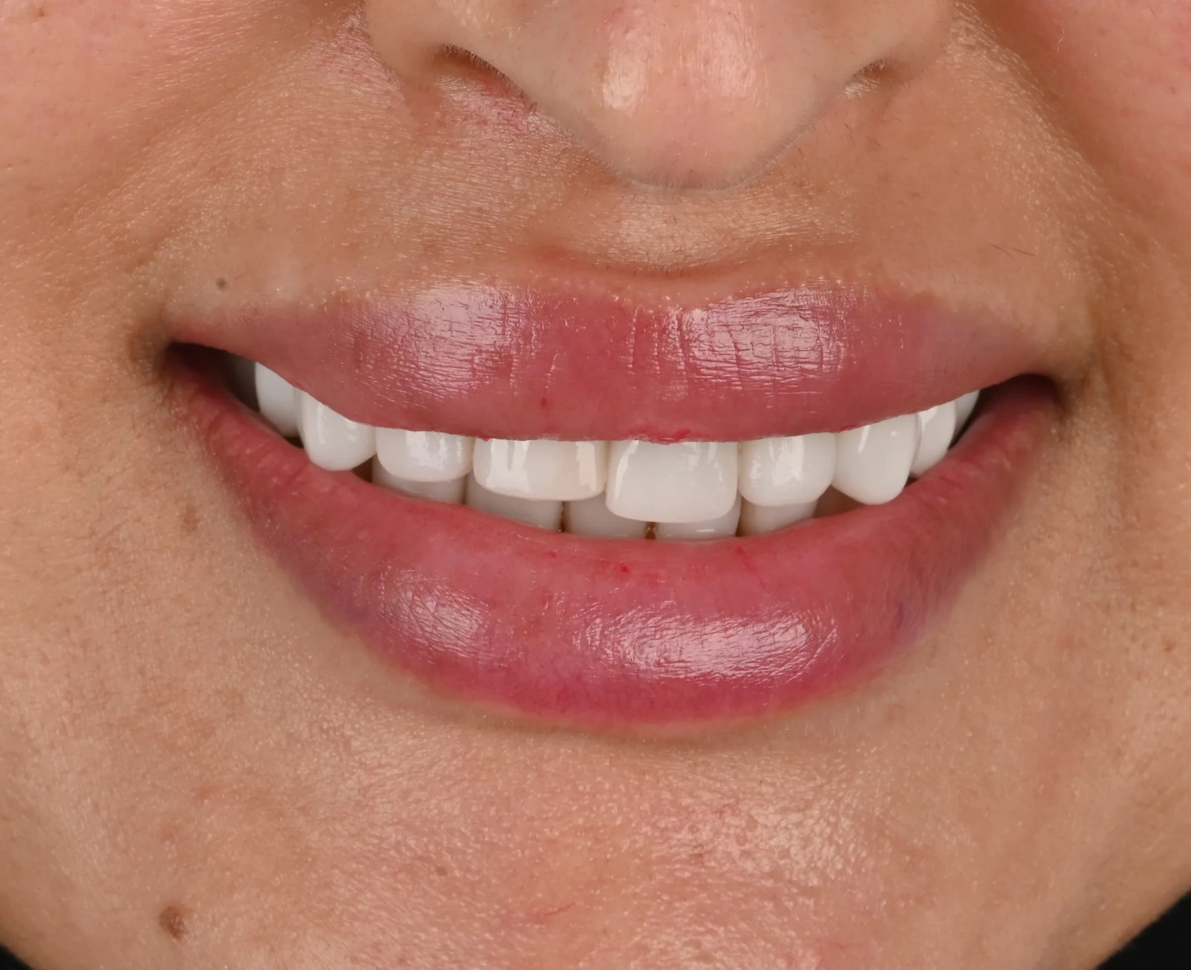 Veneers documented across five views — before treatment