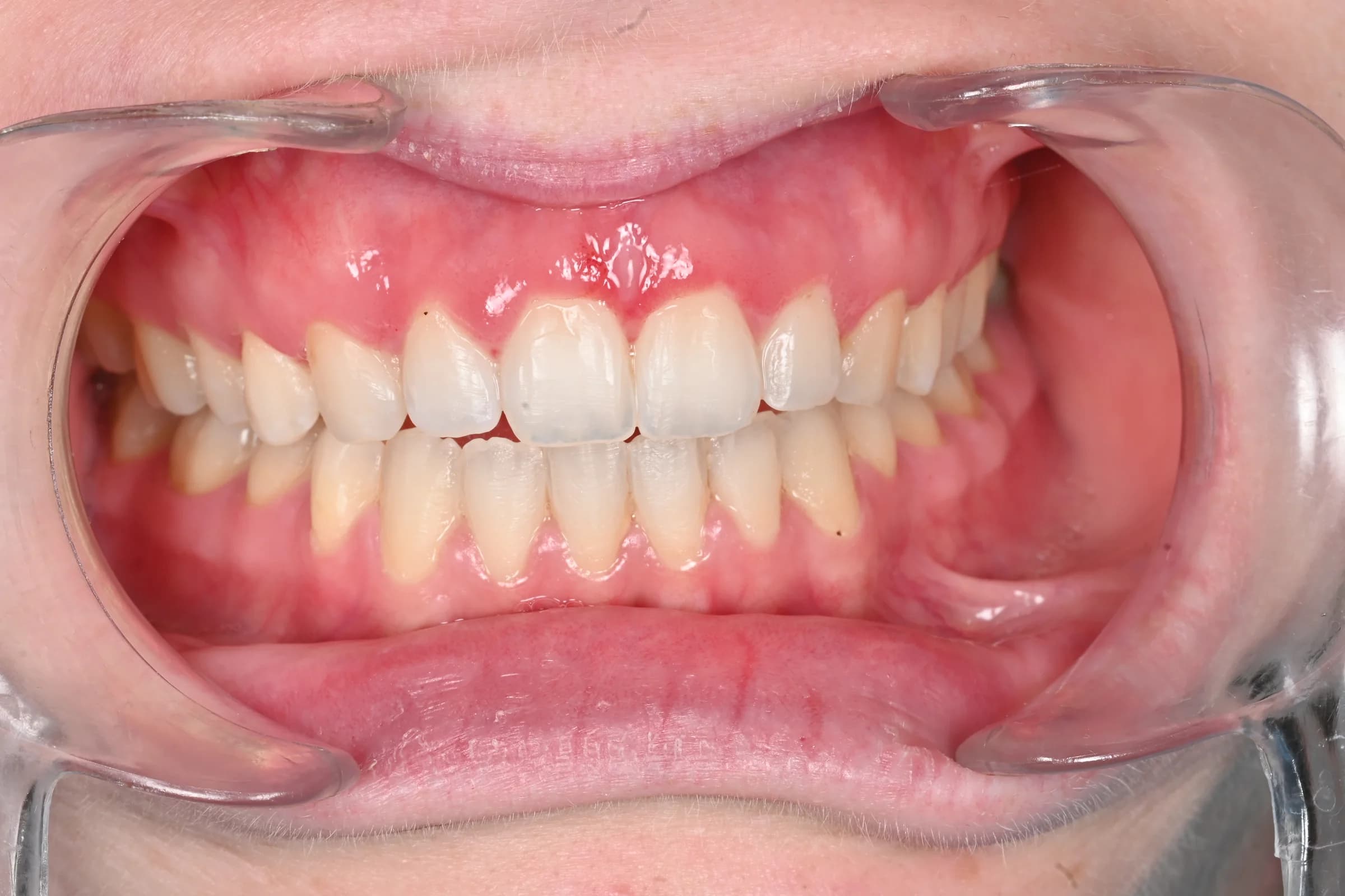 Gum reshaping around the front teeth — after treatment