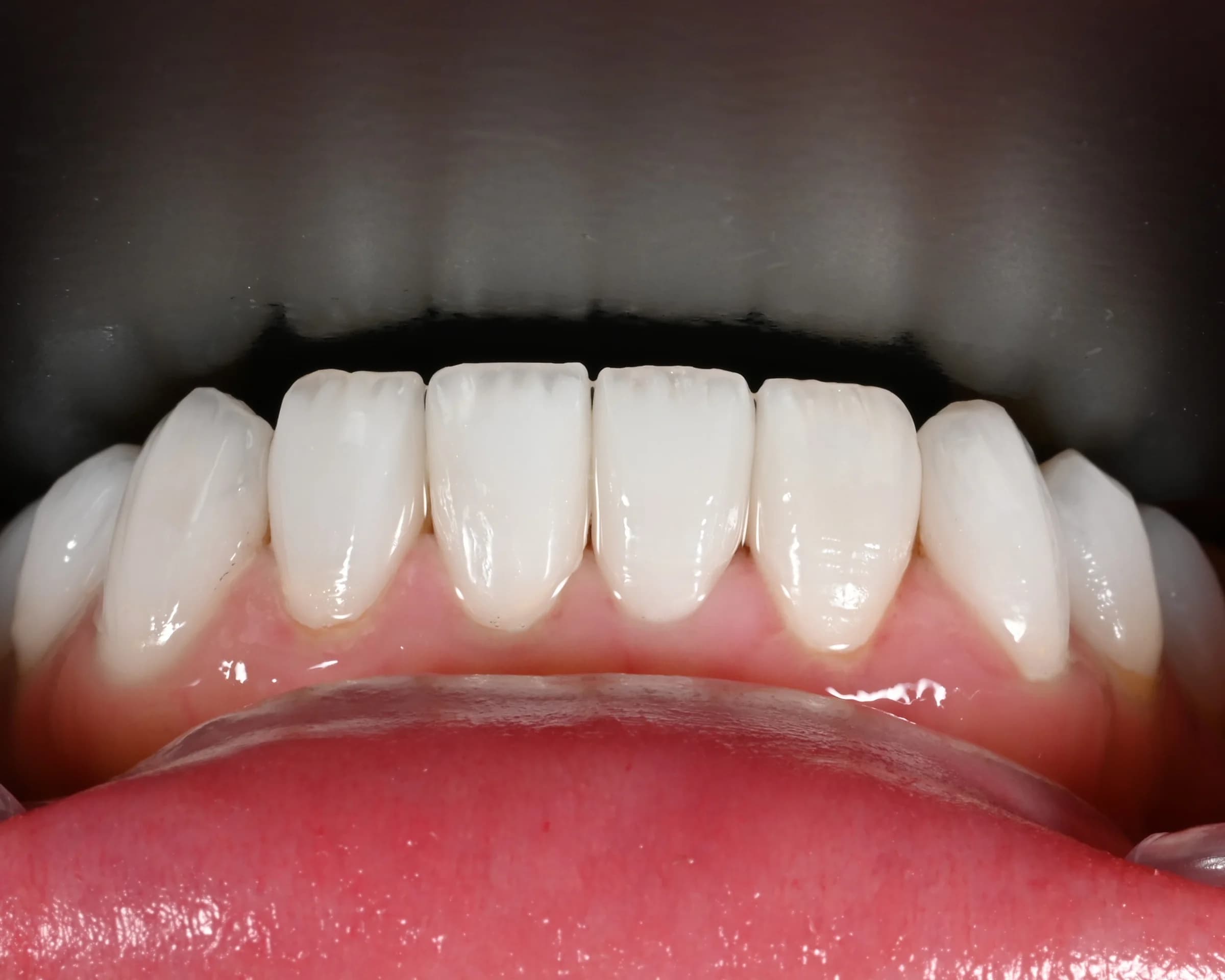 Replacing older veneers and crowns — after treatment