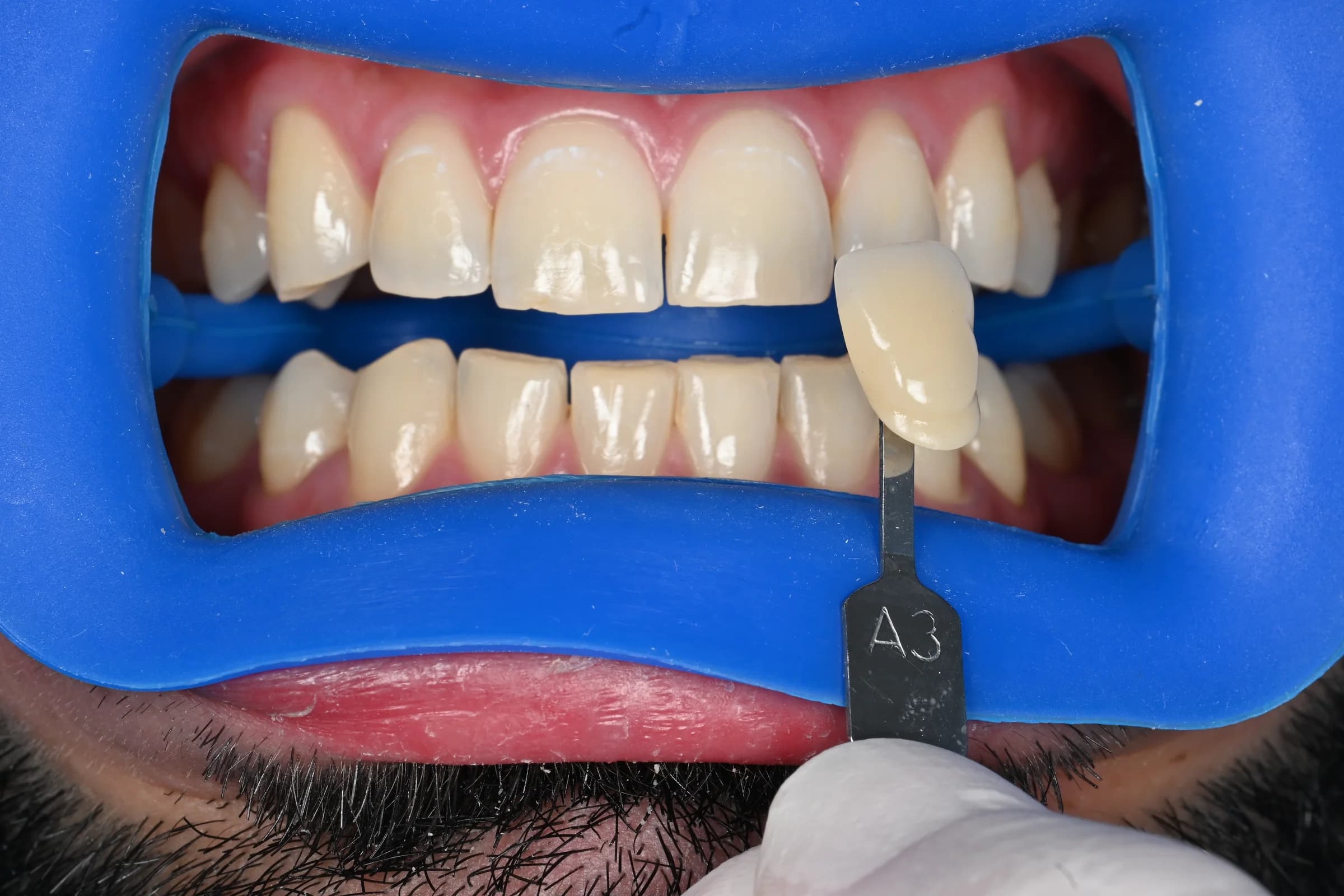 An even, natural whitening result — before treatment