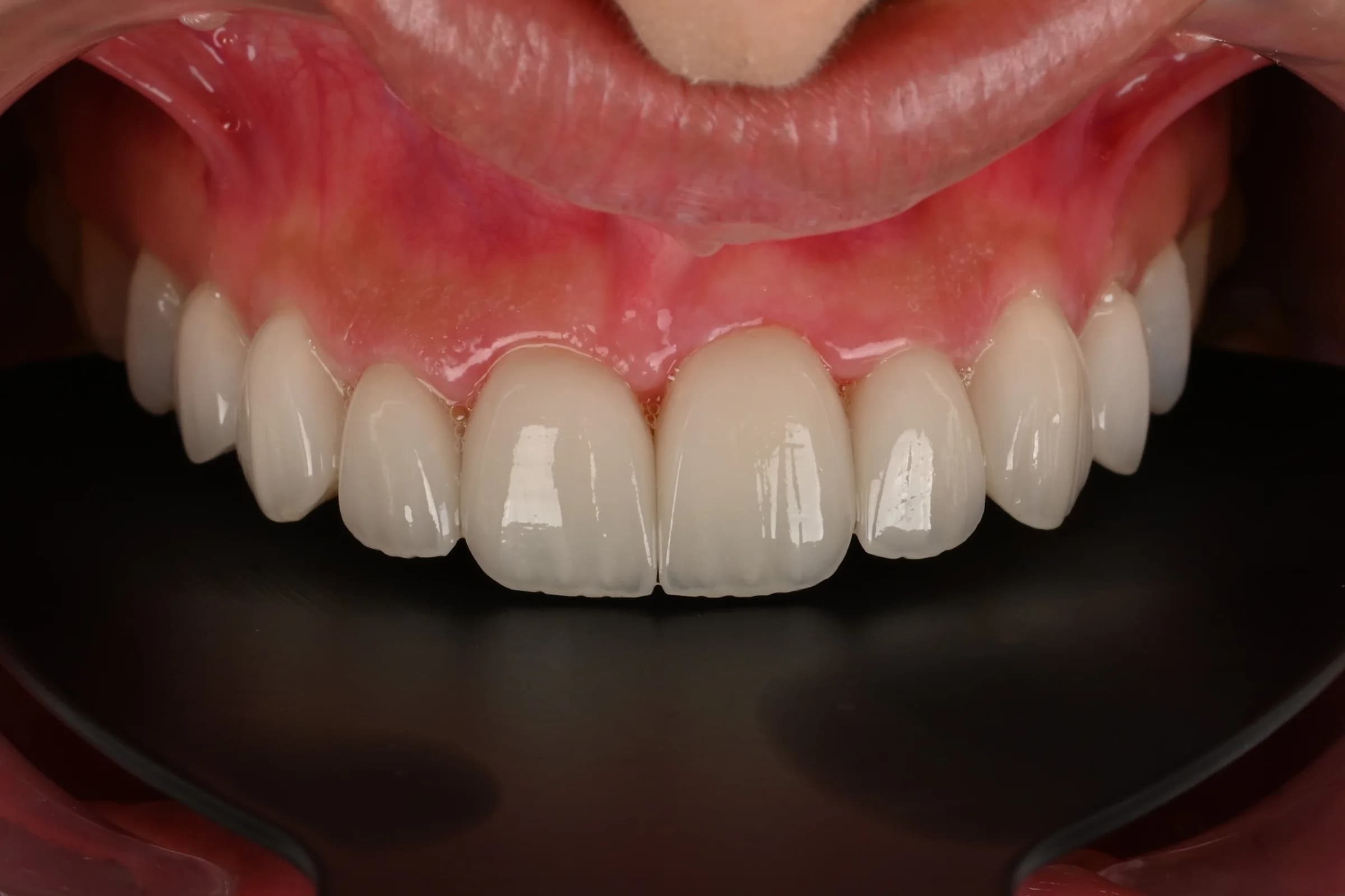 Veneers designed around the existing smile — after treatment