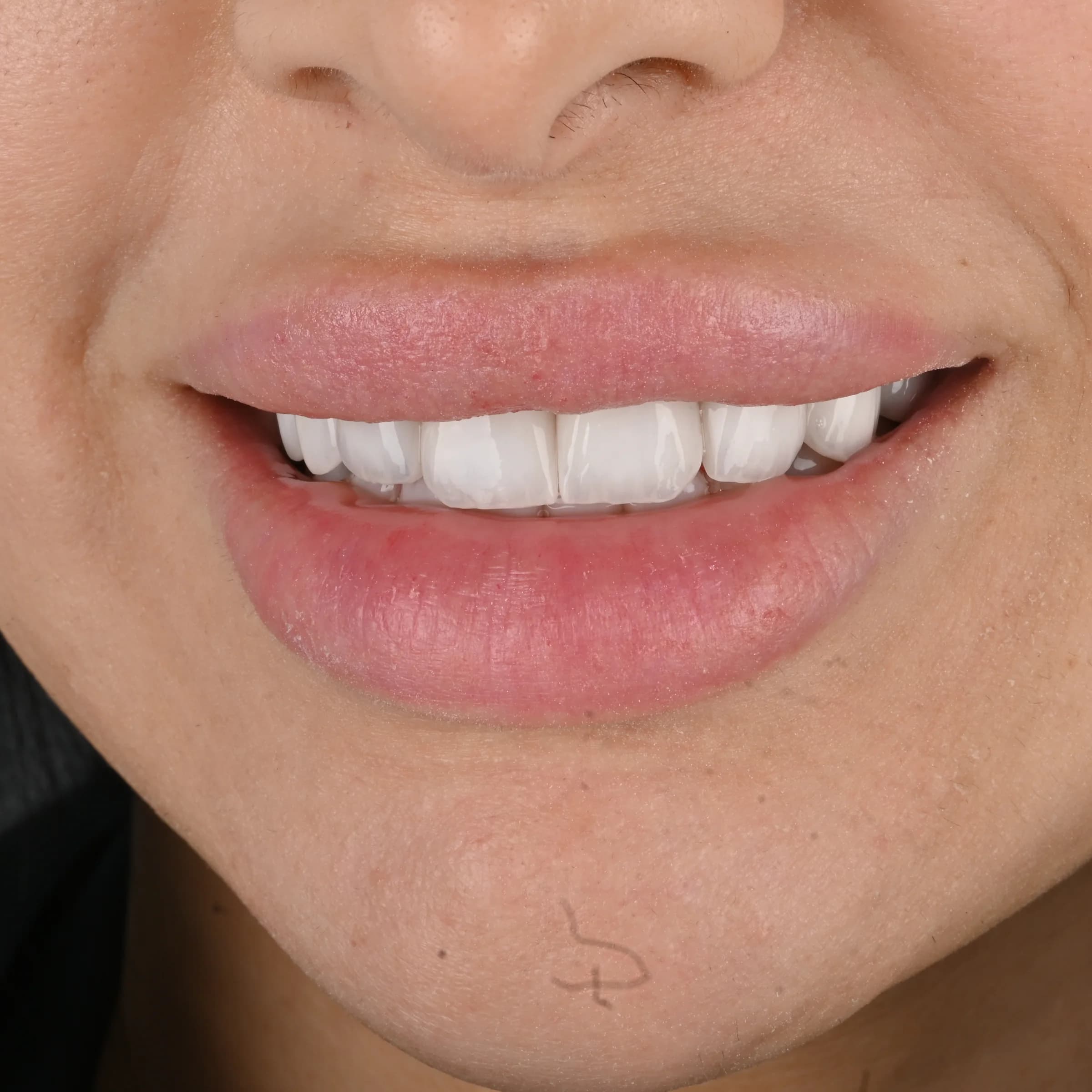 Replacing older veneers and crowns — photo 4