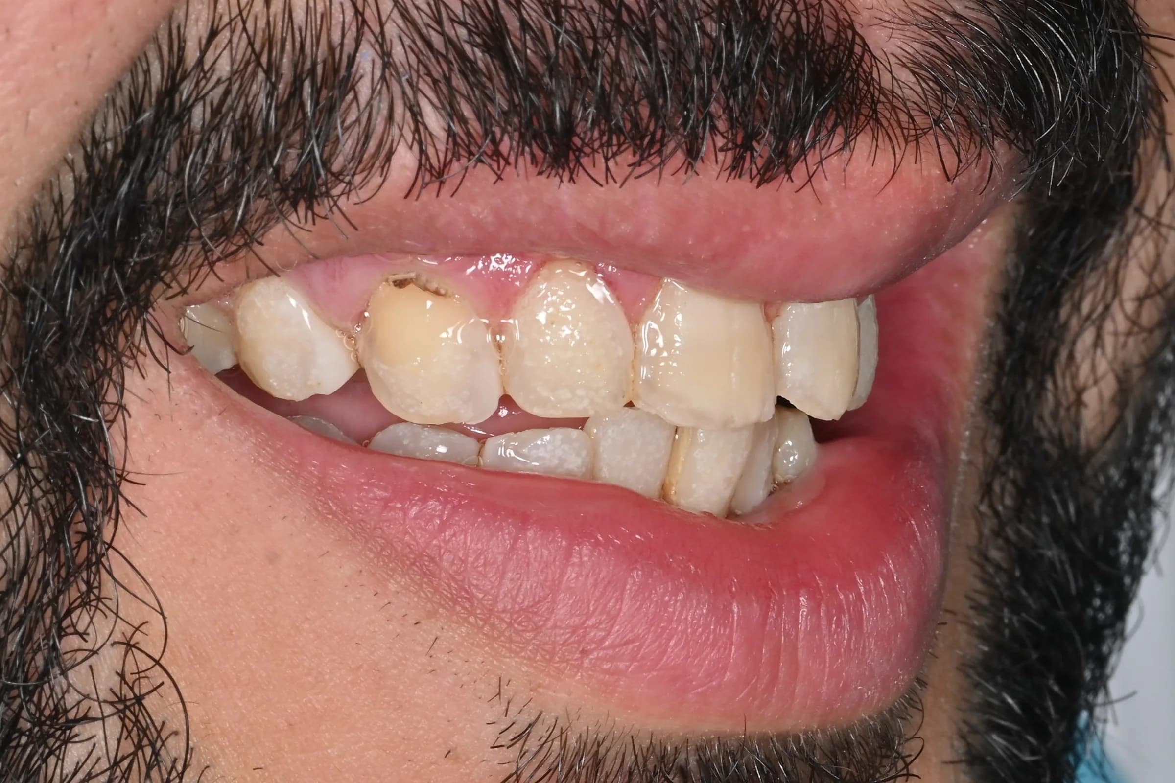 Rebuilding worn and uneven edges — before treatment