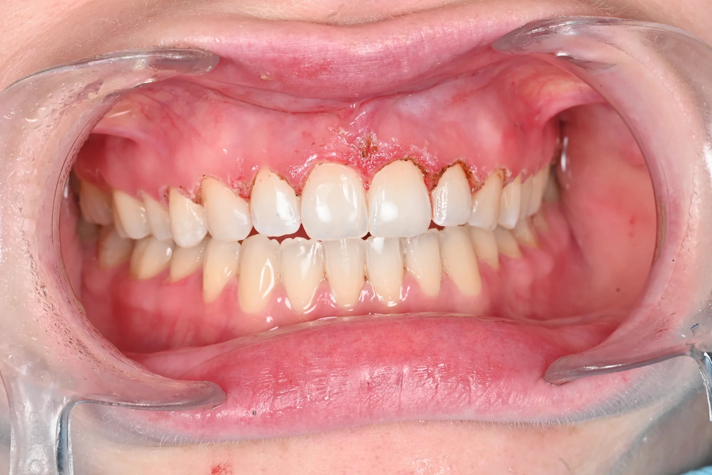 Gum reshaping around the front teeth — before treatment