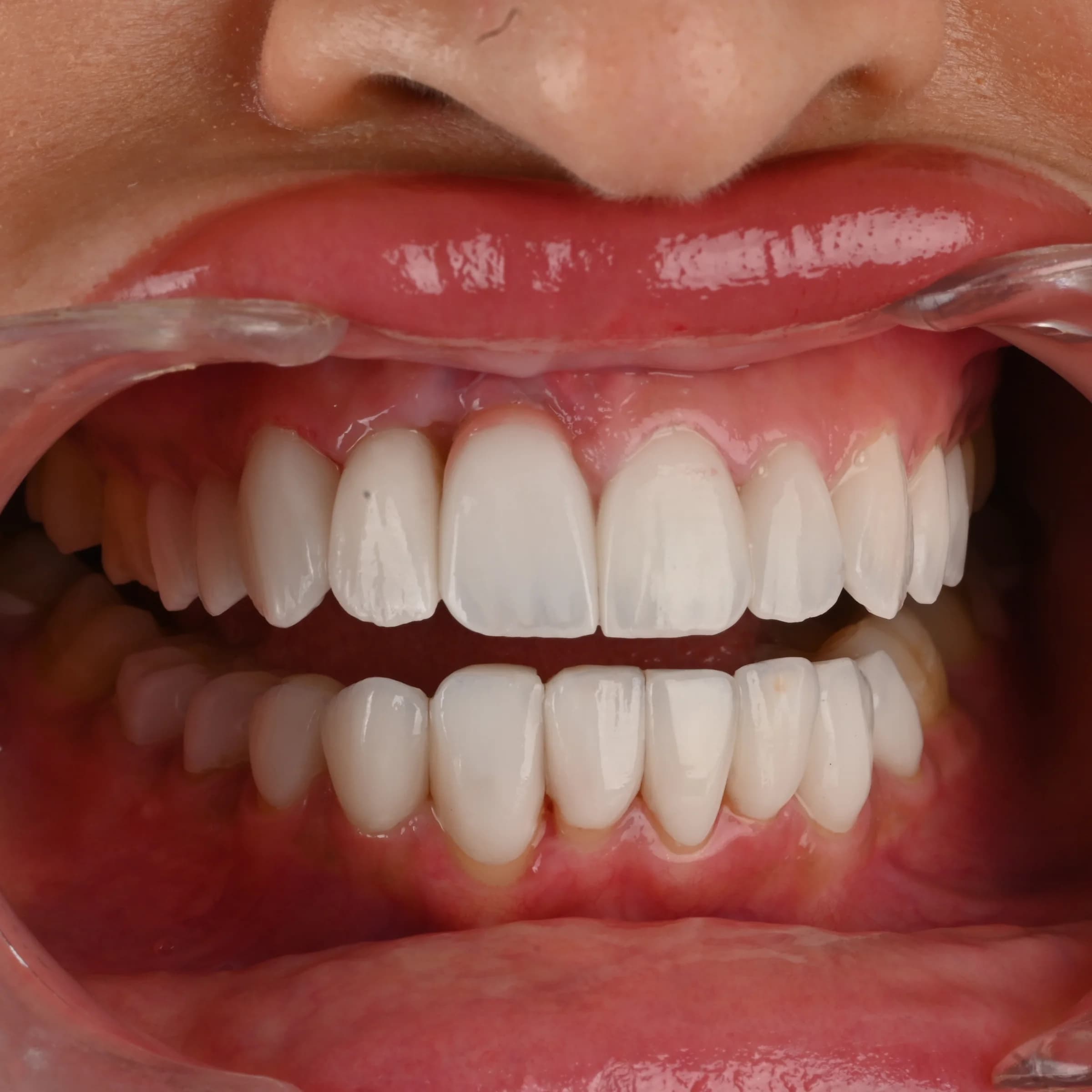 Veneers documented across five views — photo 4