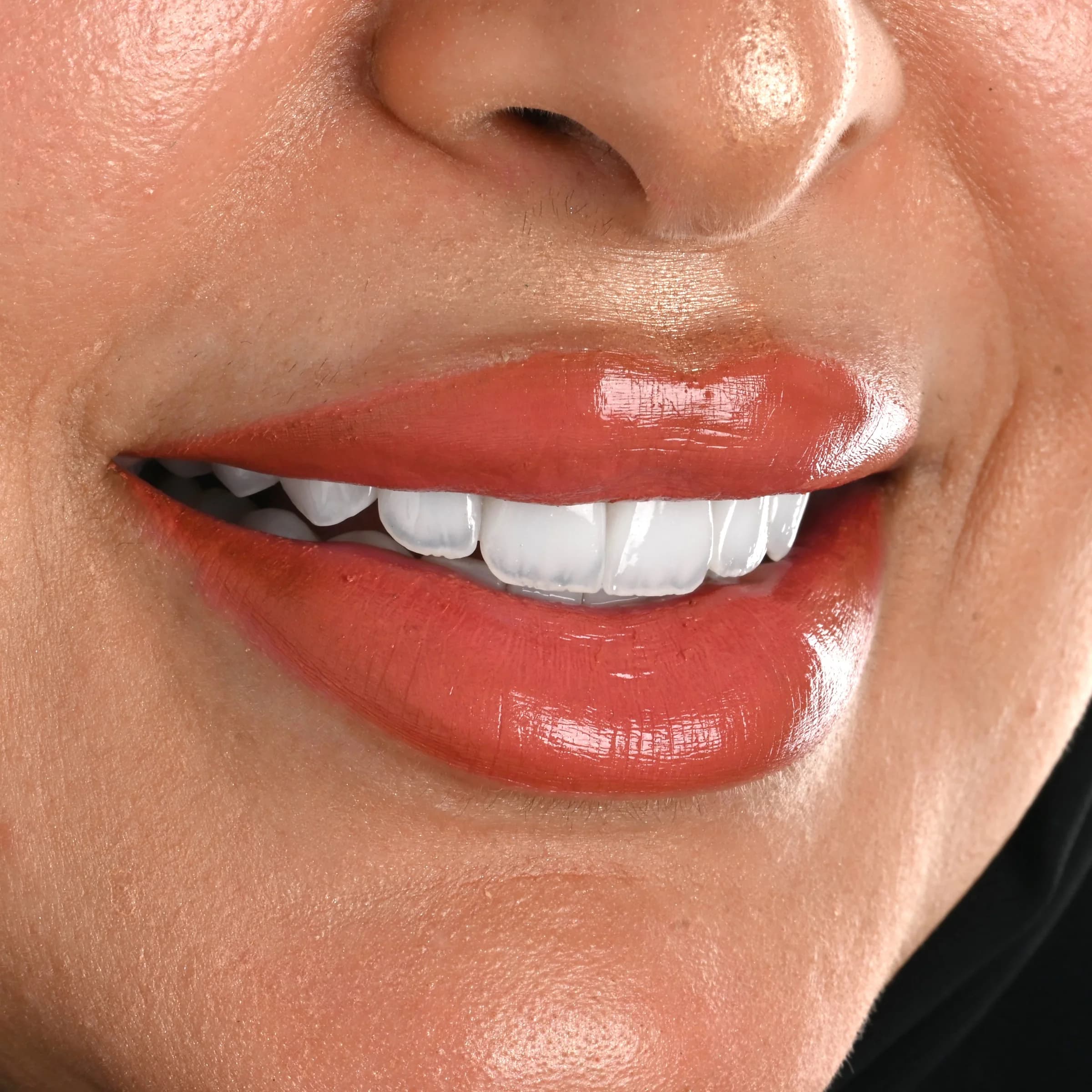 Porcelain veneers, upper and lower — after treatment