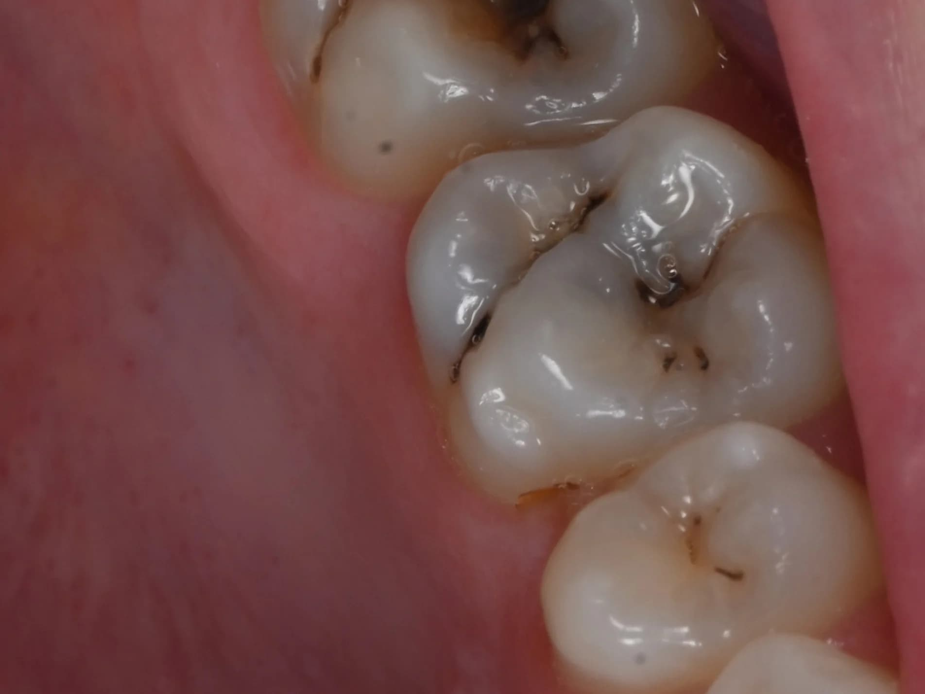 Restoring the biting surface — before treatment