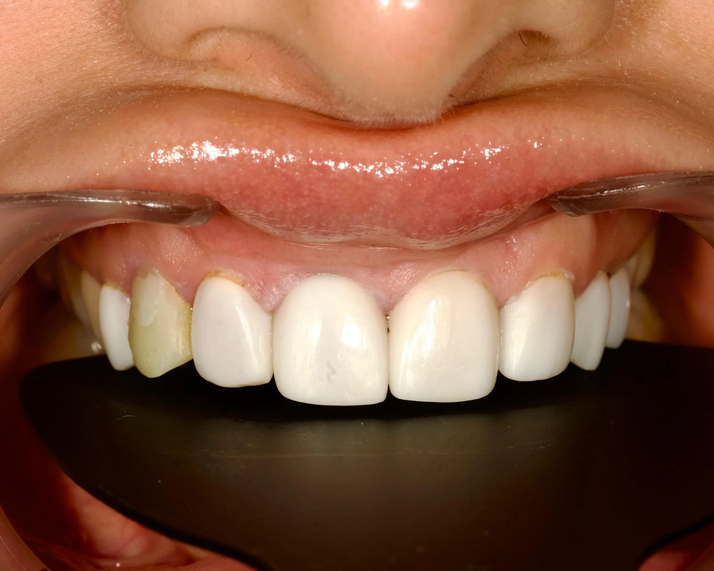 Replacing older veneers and crowns — before treatment