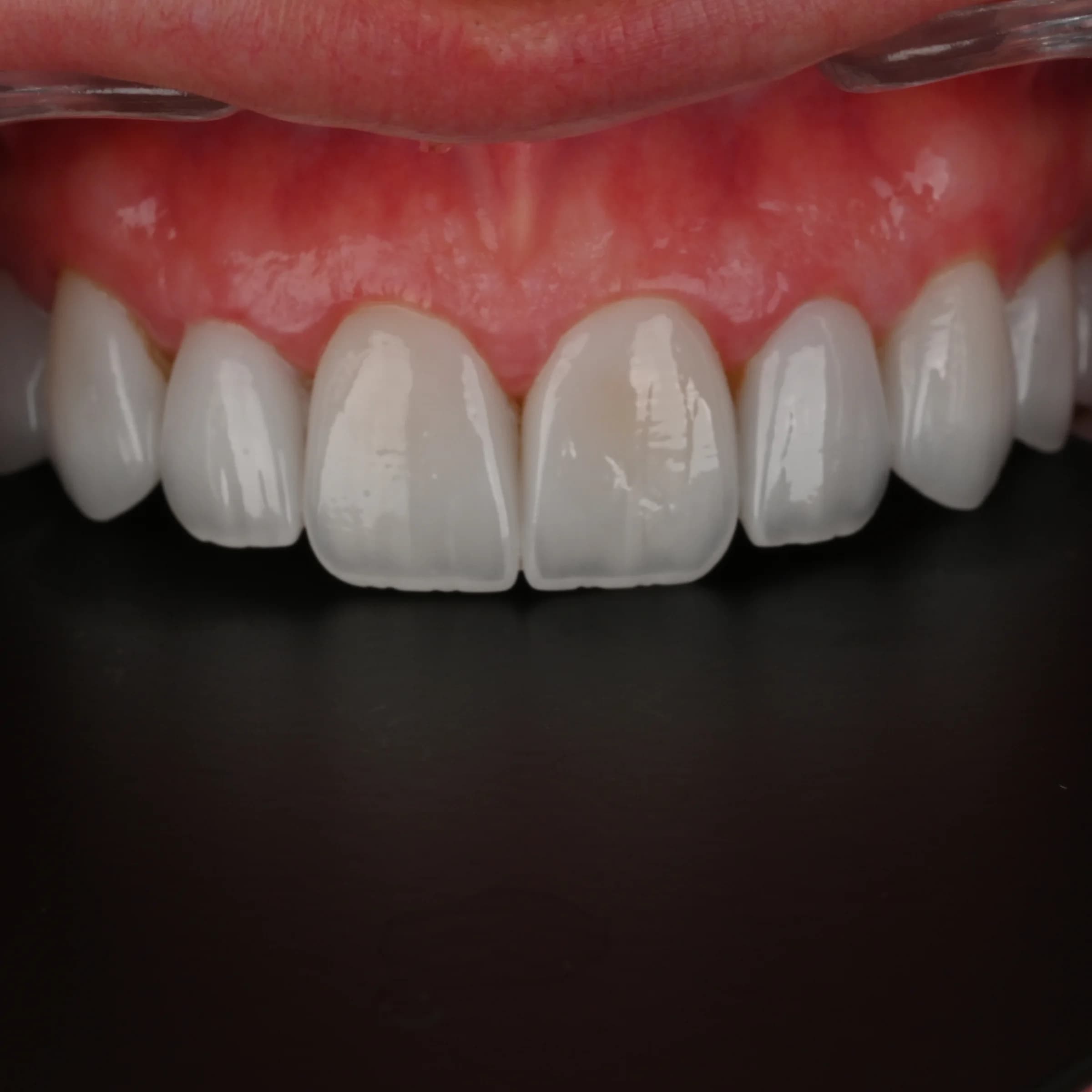 Veneers on the upper front teeth — photo 1