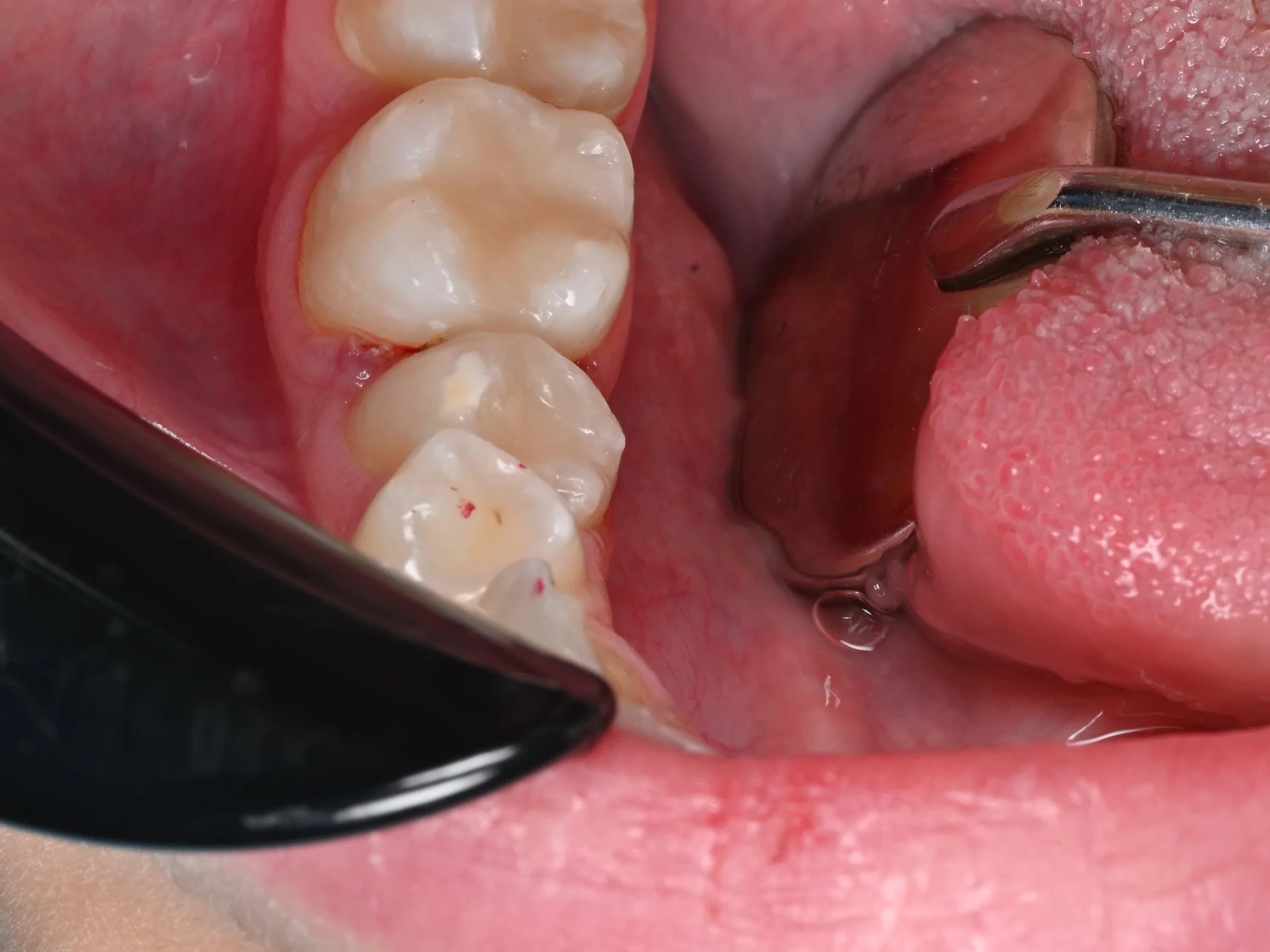 Decay removed, molars rebuilt — after treatment