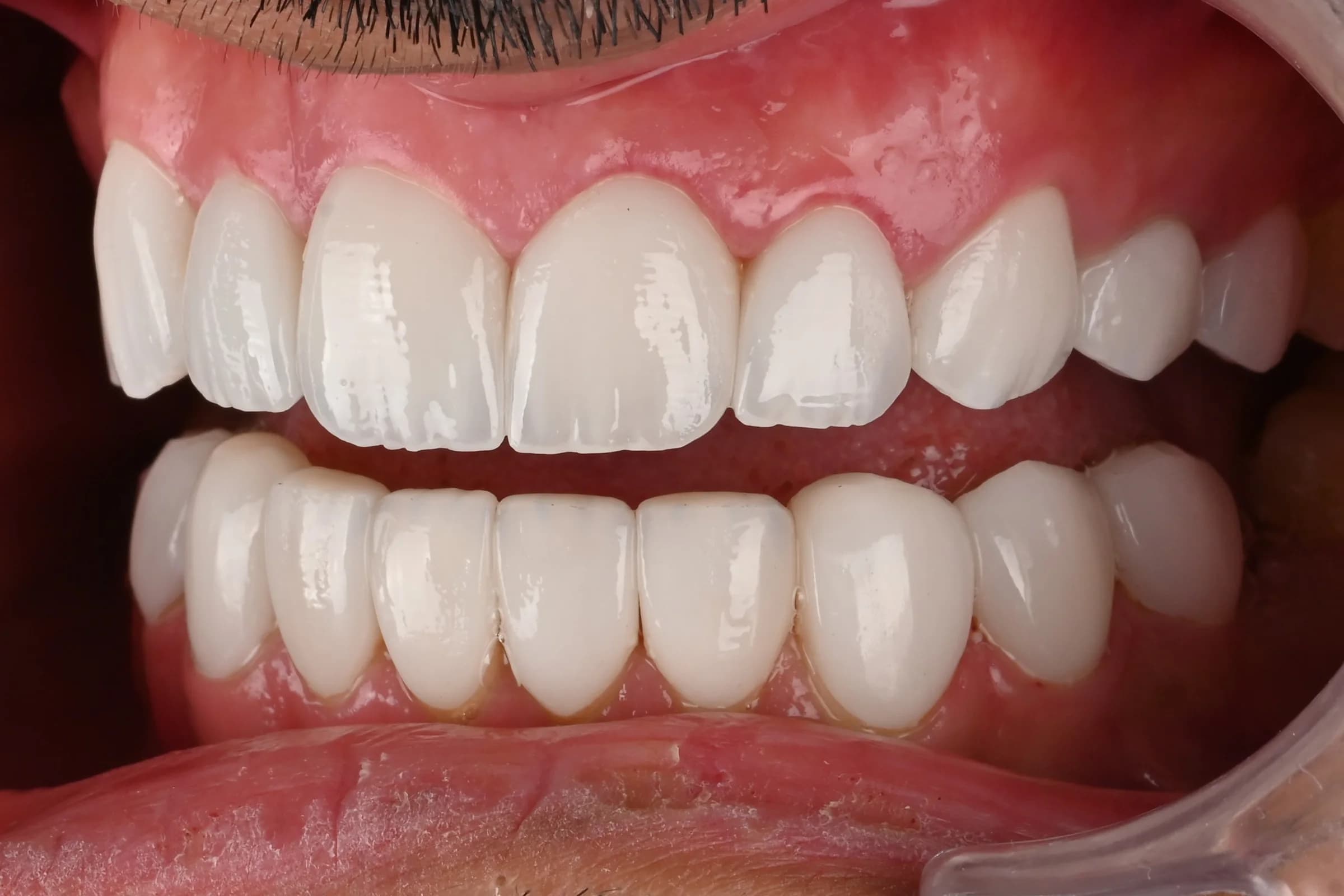 A full veneer case, six views — after treatment