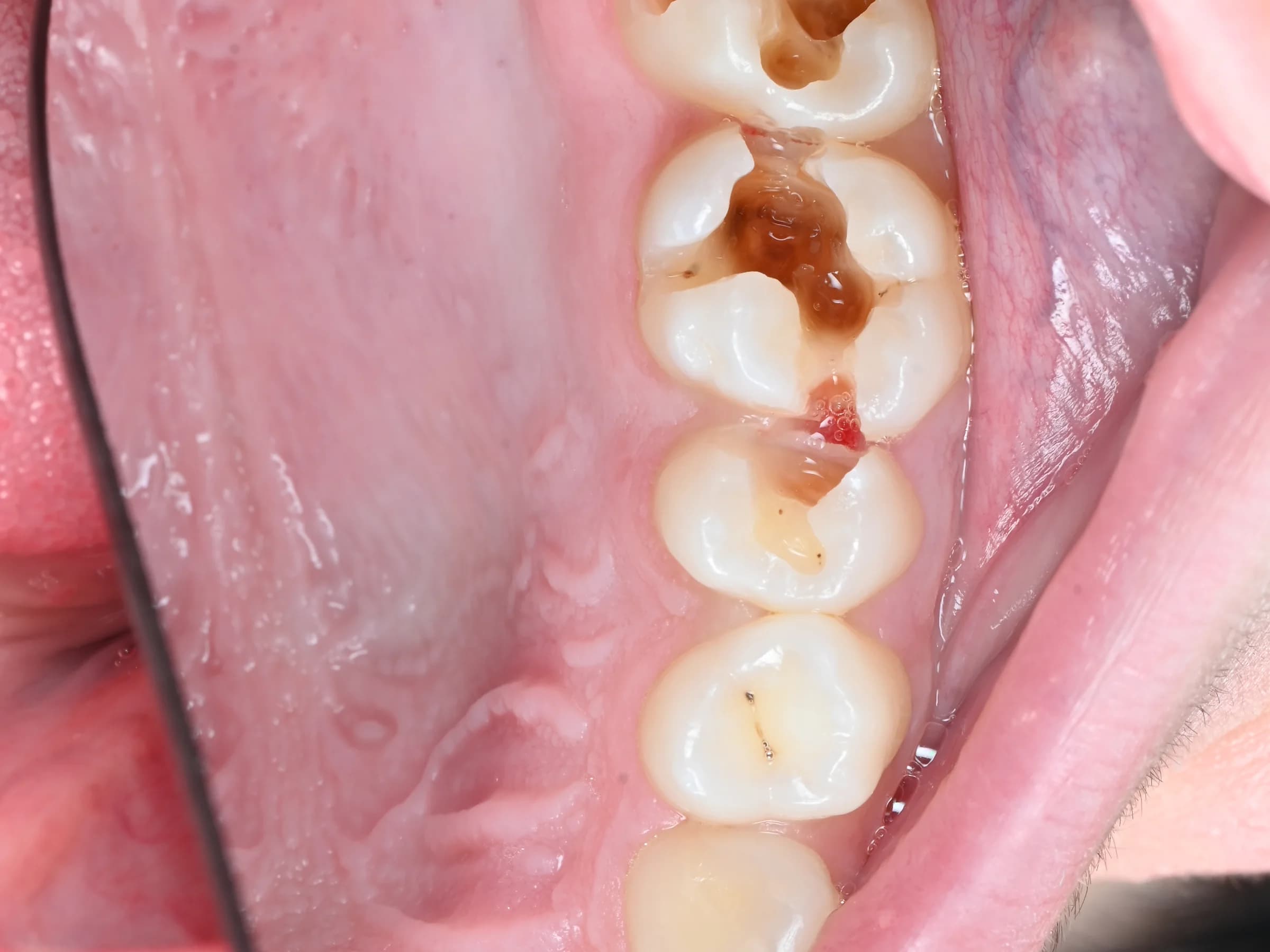 Fillings that match the tooth — before treatment