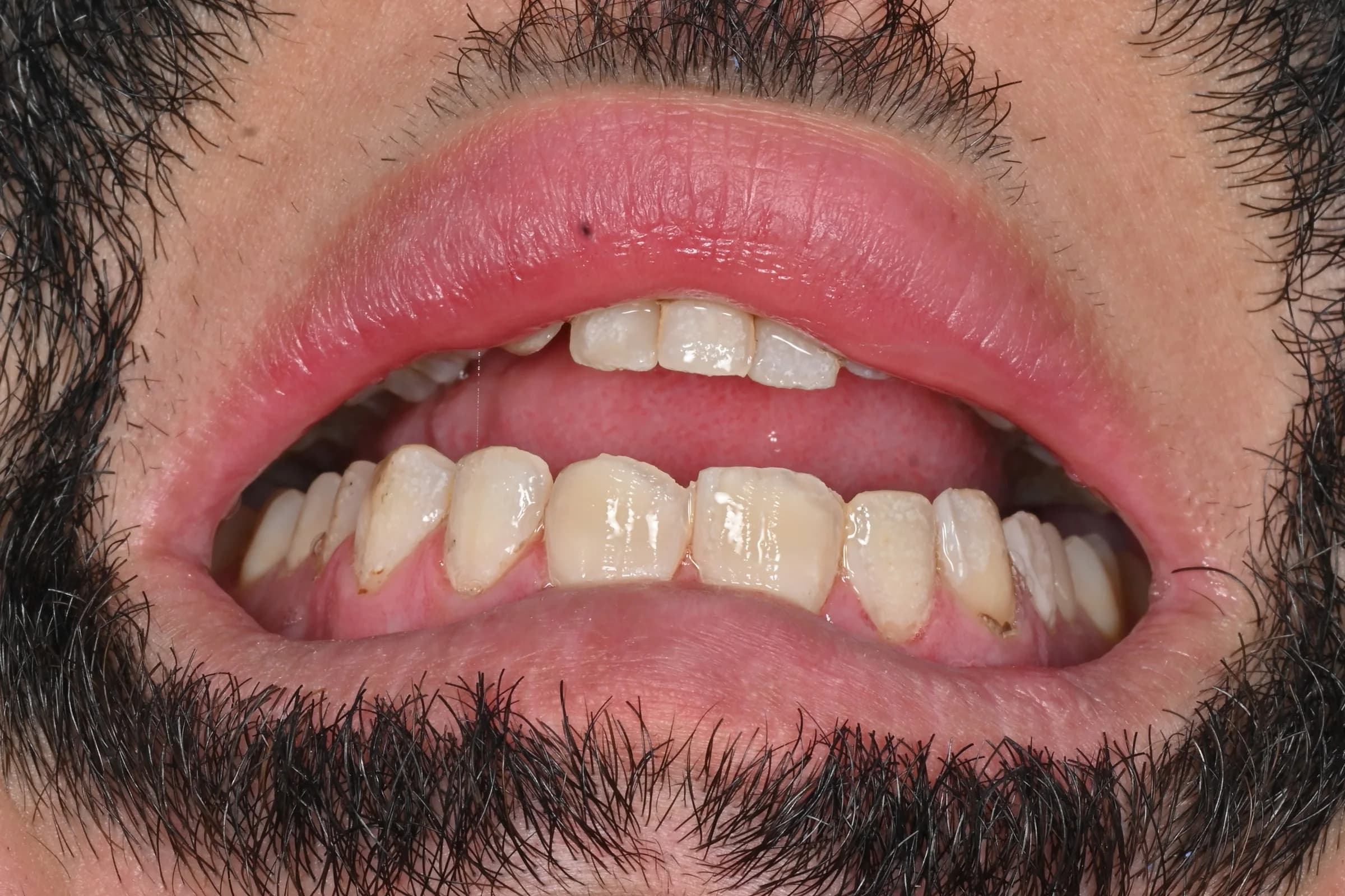 Rebuilding worn and uneven edges — before treatment