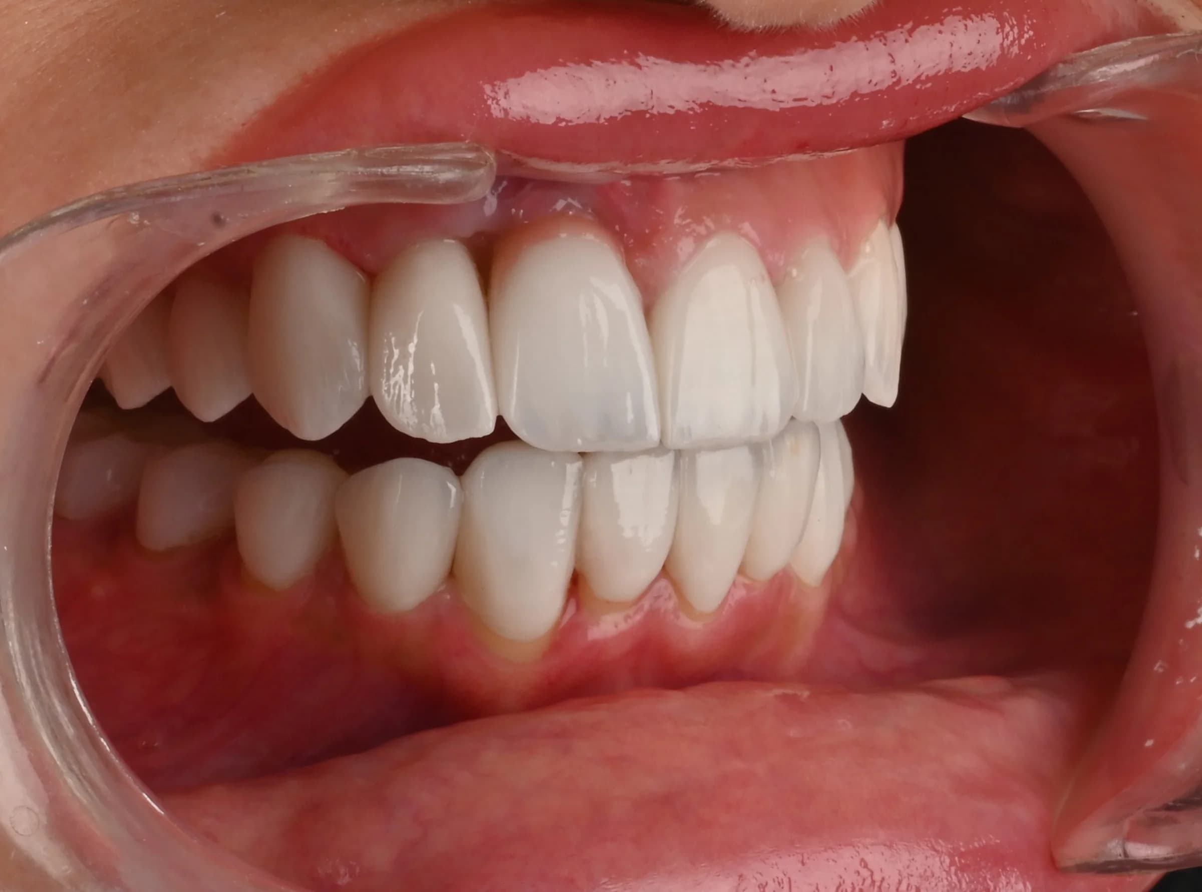 Veneers documented across five views — after treatment