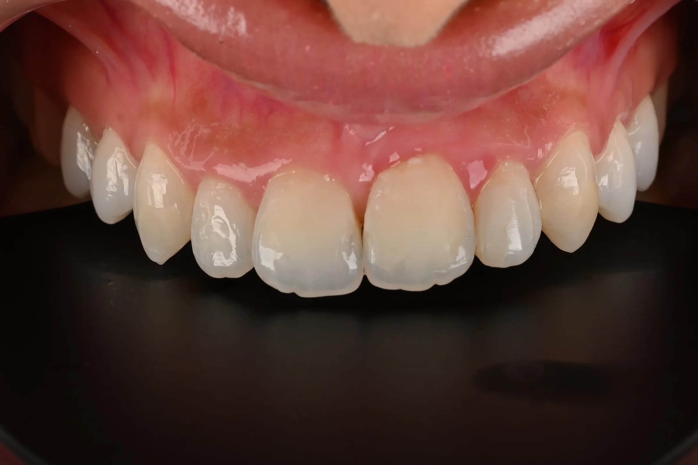 Veneers designed around the existing smile — before treatment