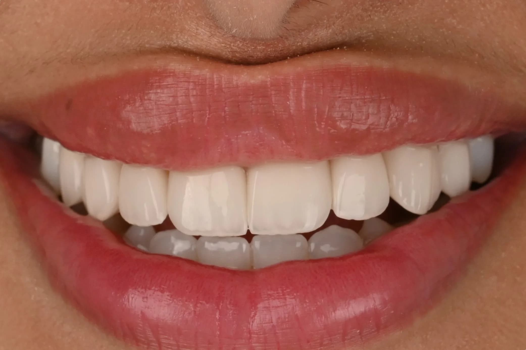 Veneers designed around the existing smile — after treatment