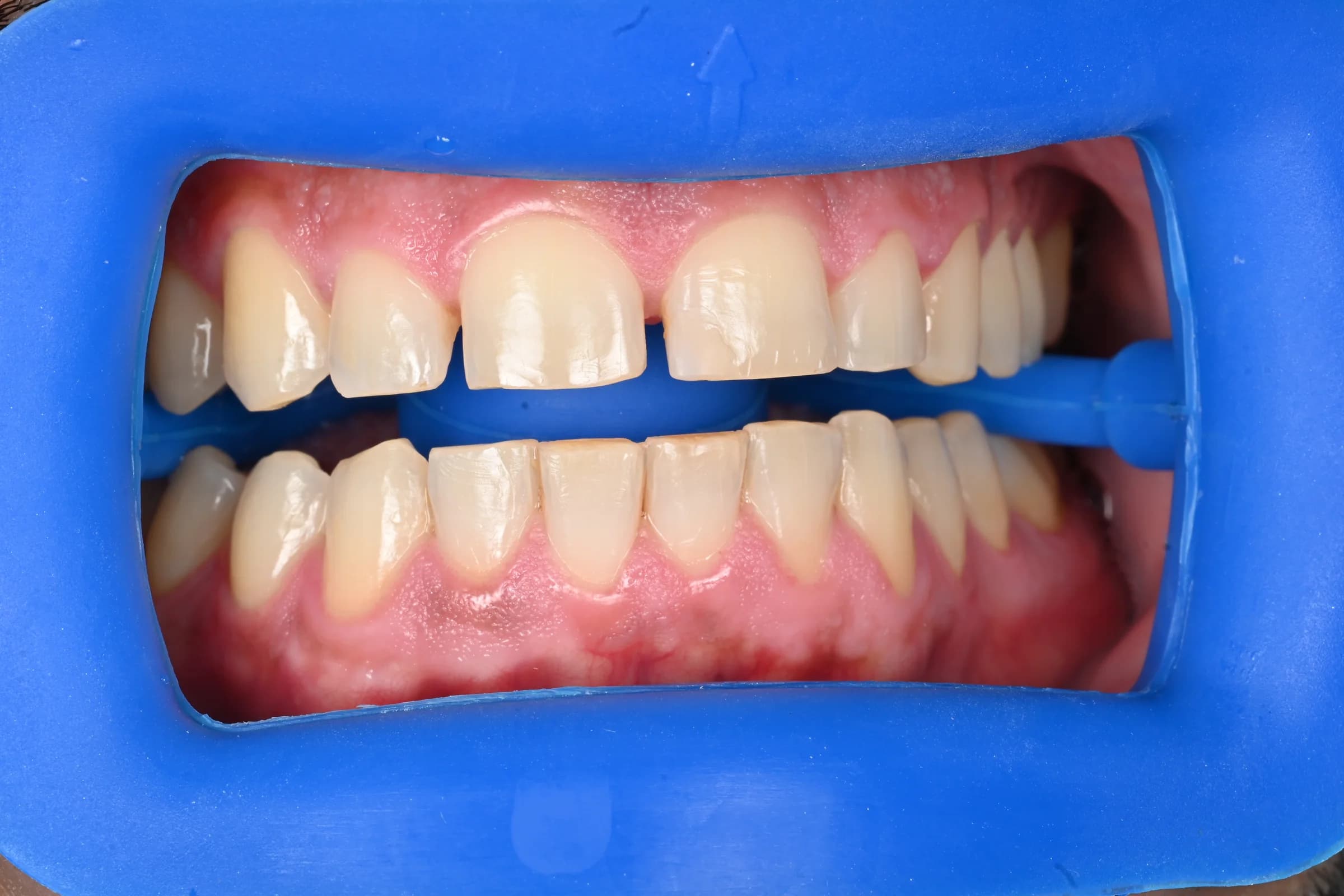Whitening across both arches, shade matched — Upper and lower arches — before treatment