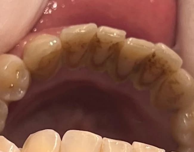 Scale and polish: removing hardened build-up — before treatment