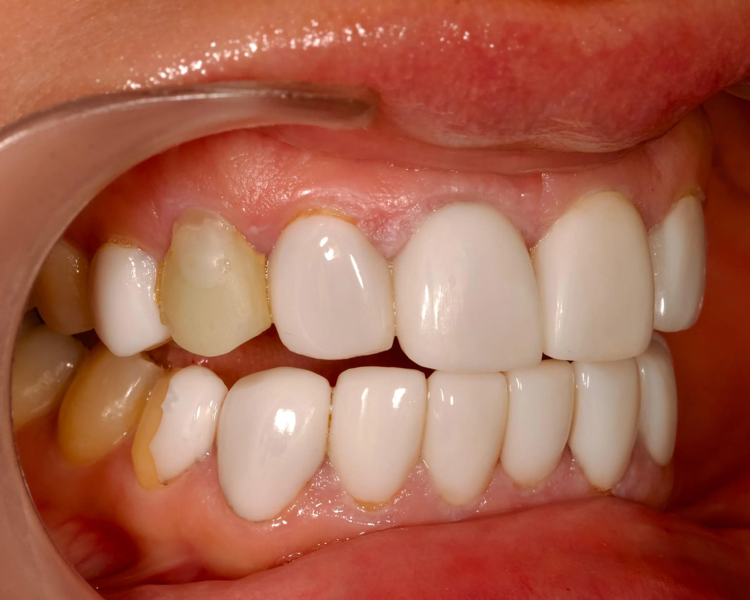 Replacing older veneers and crowns — before treatment