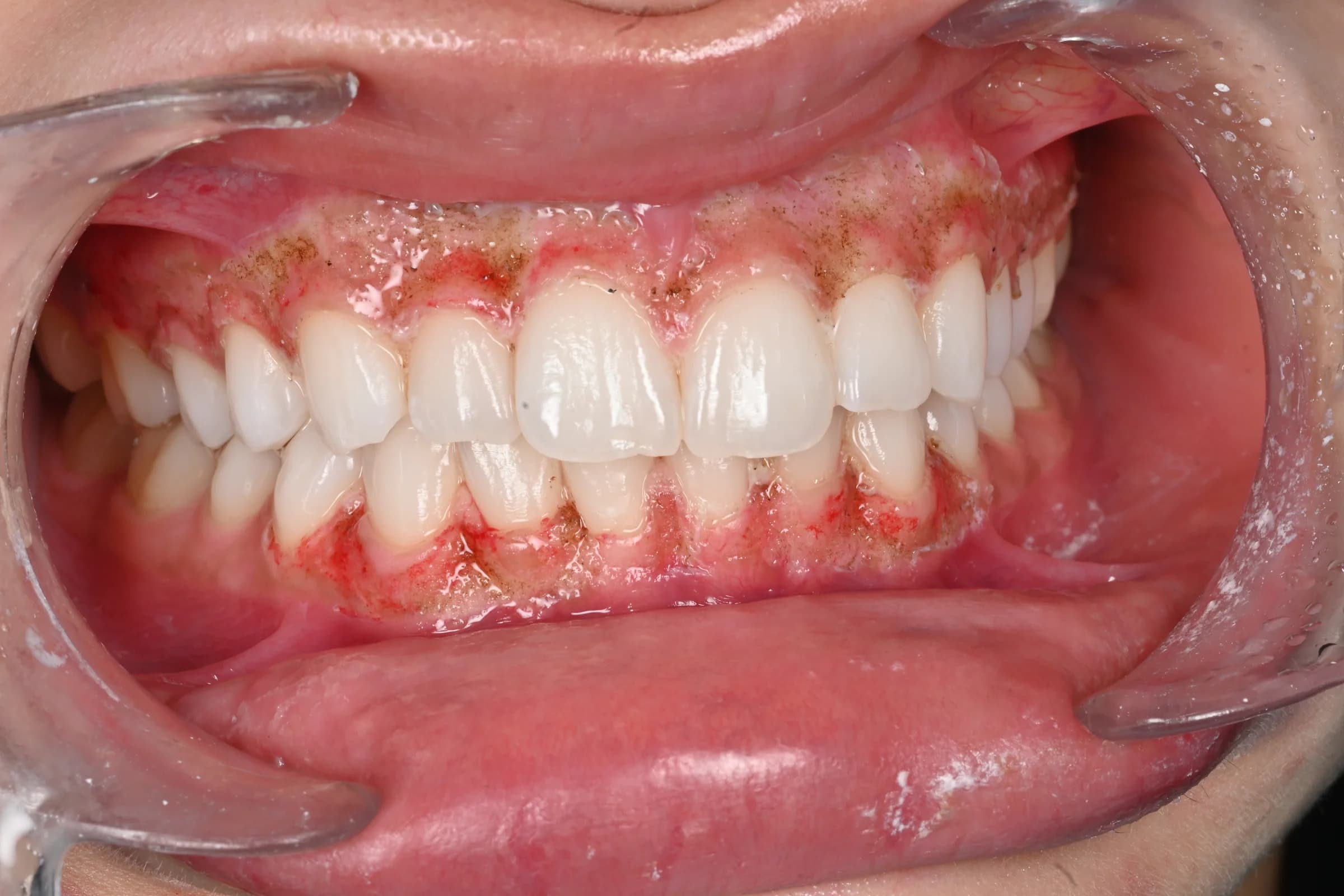 Evening out an uneven gum line — before treatment