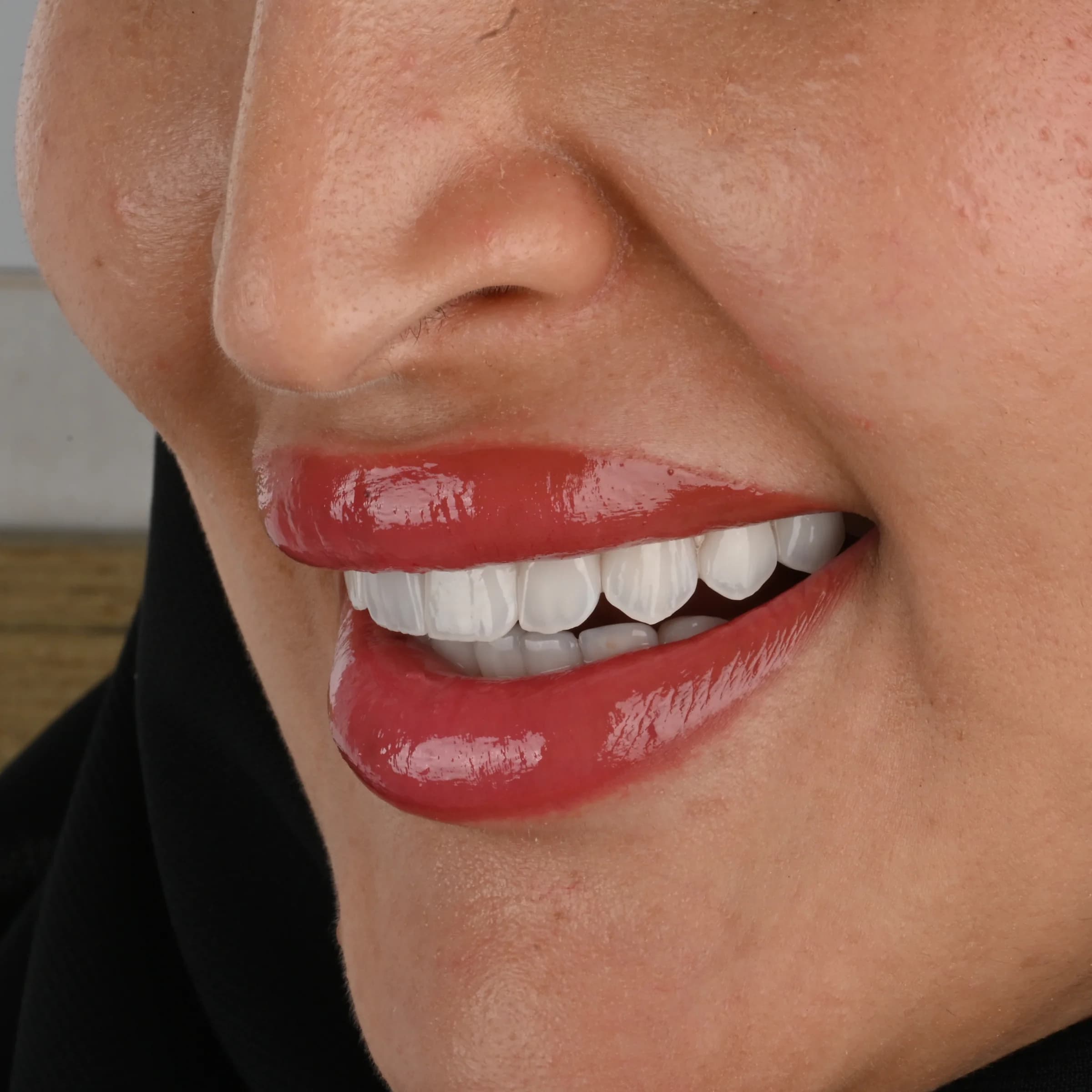 Veneers documented across five views — photo 6
