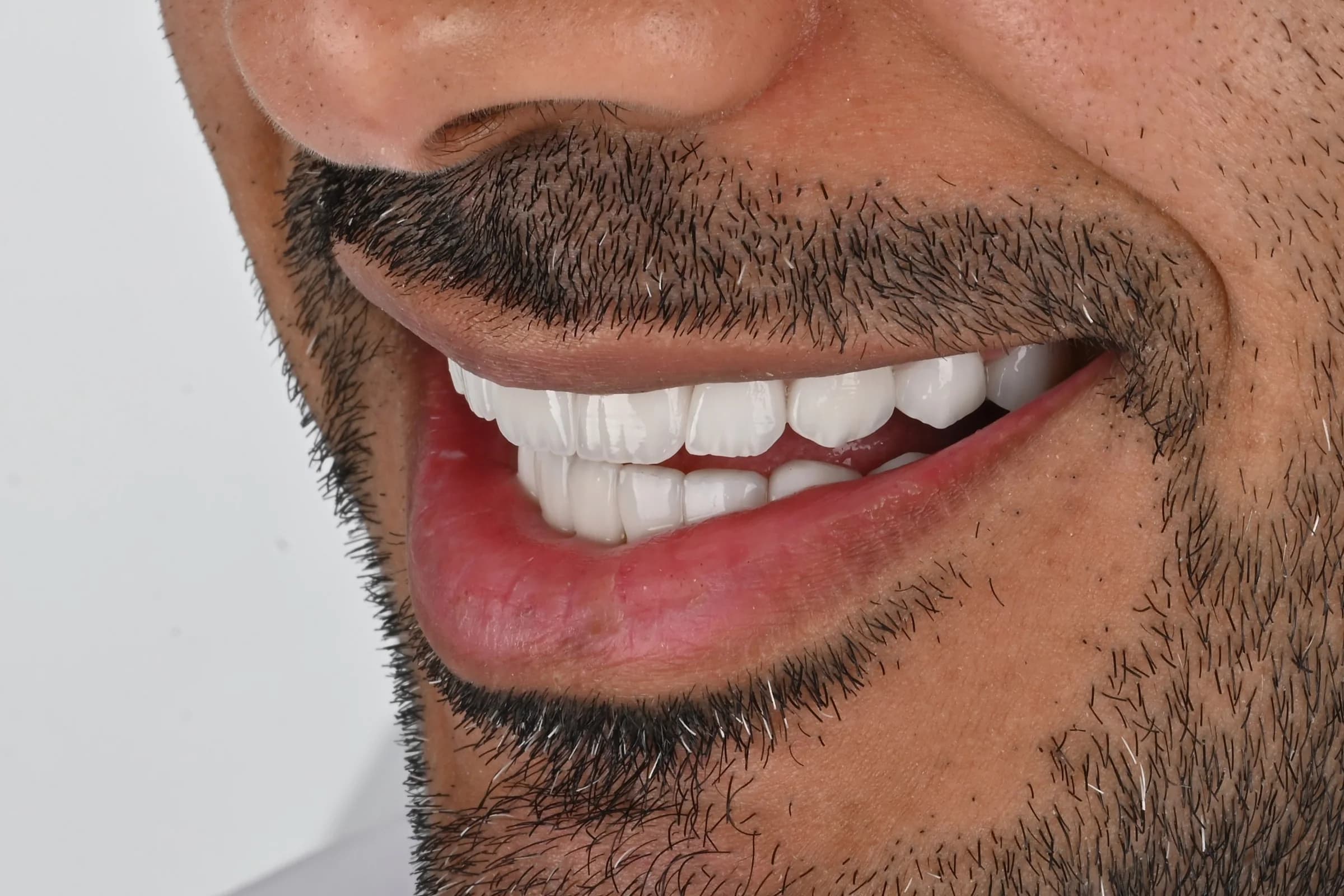 A full veneer case, six views — after treatment