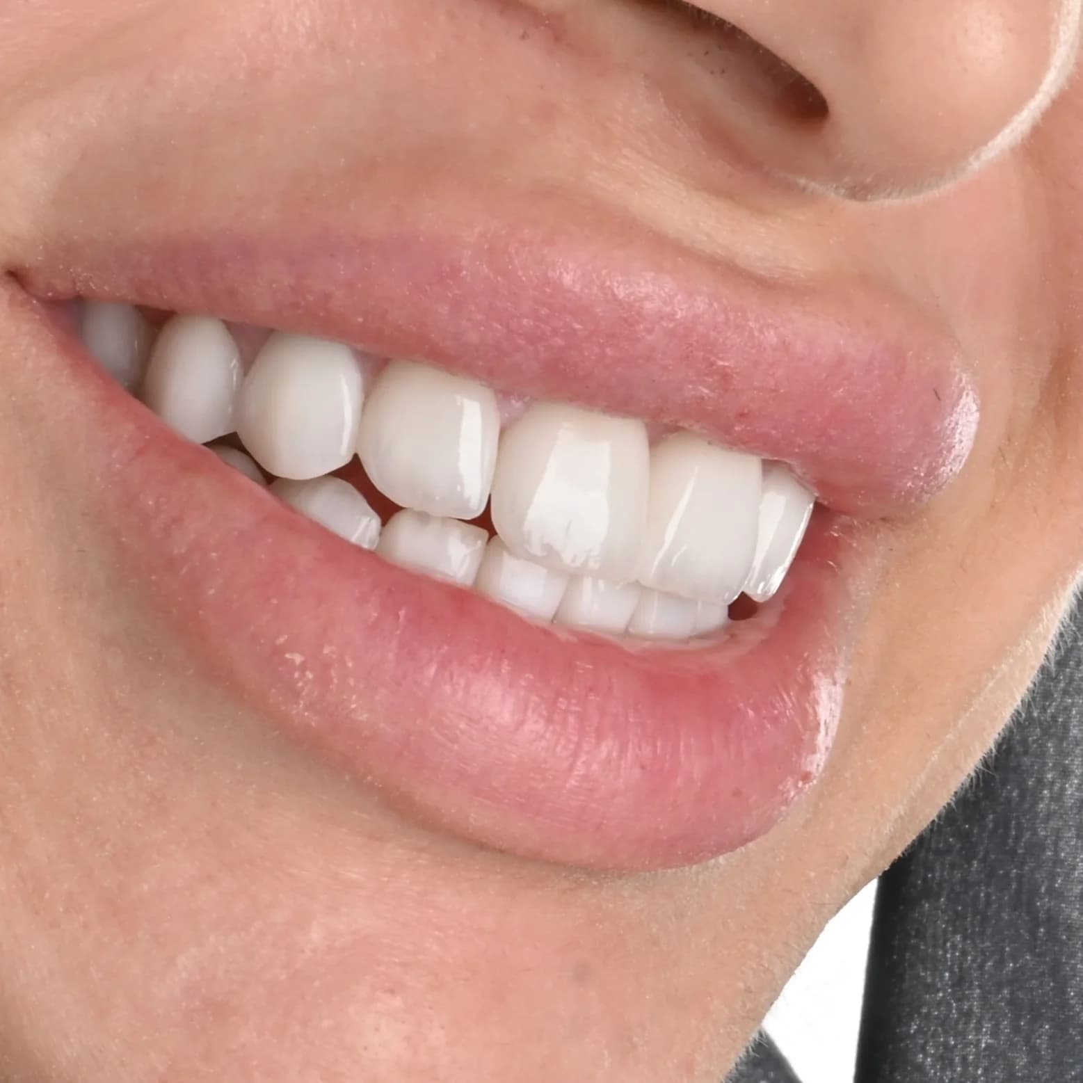Replacing older veneers and crowns — photo 1