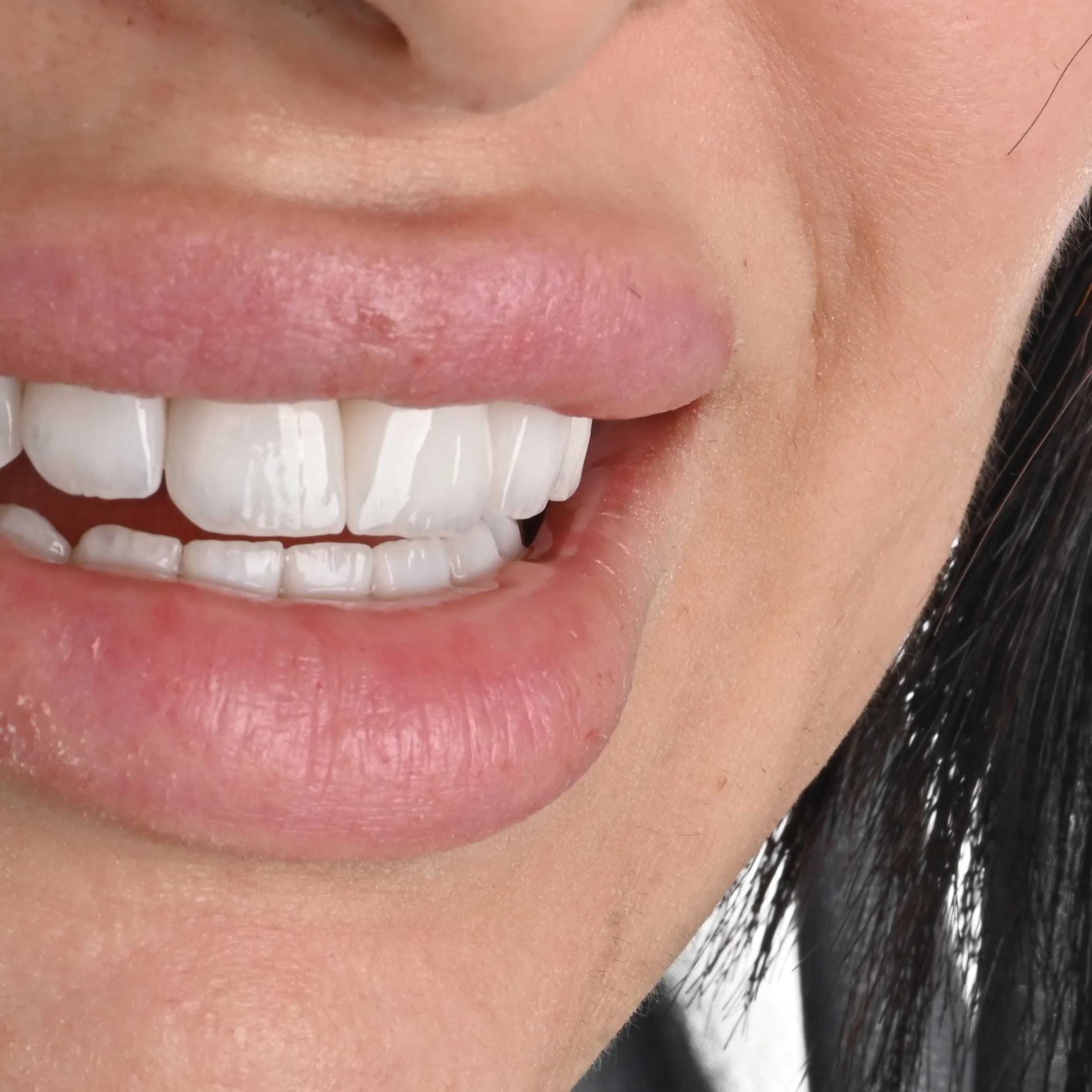 Replacing older veneers and crowns — photo 6