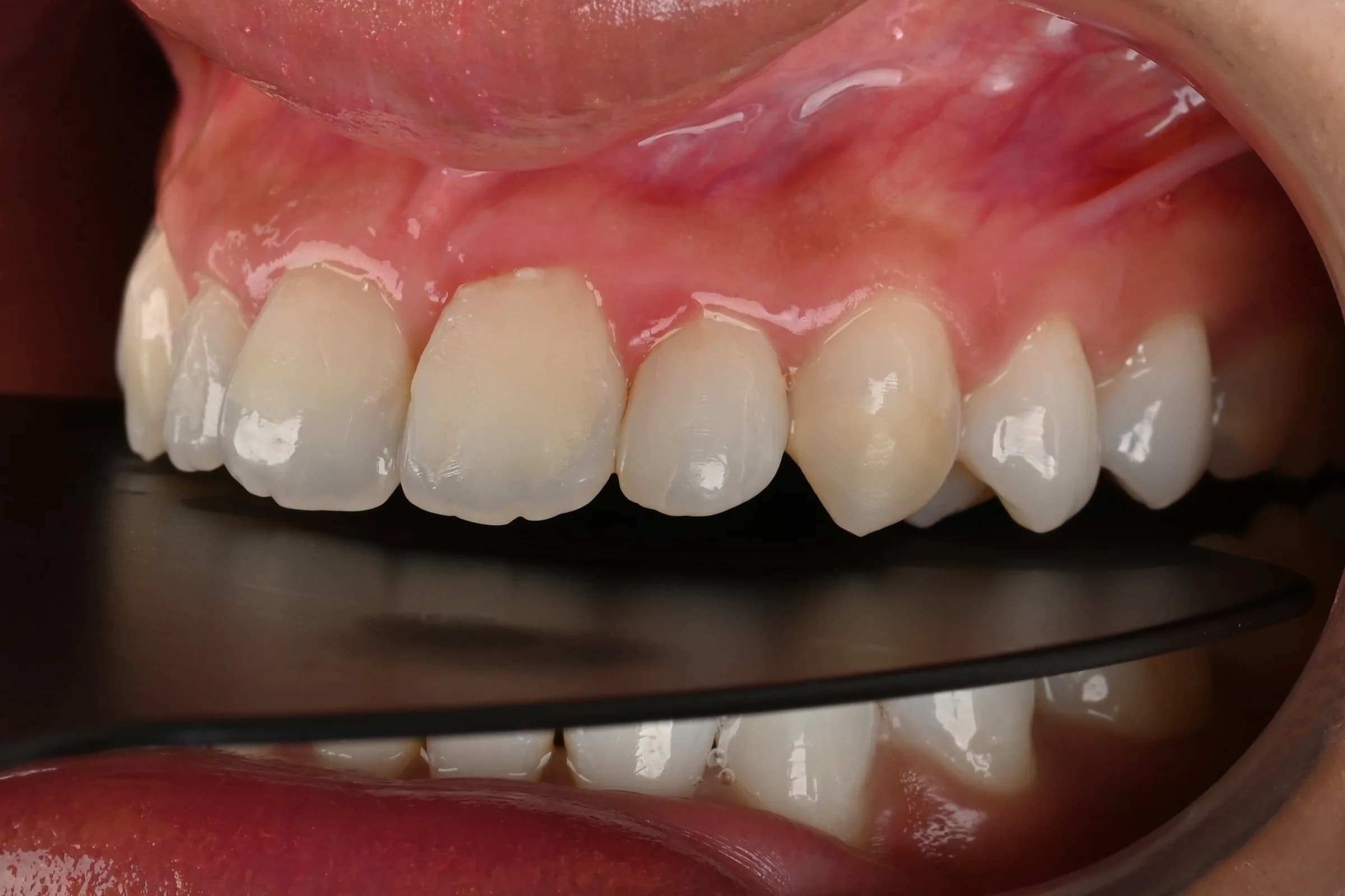 Veneers designed around the existing smile — before treatment