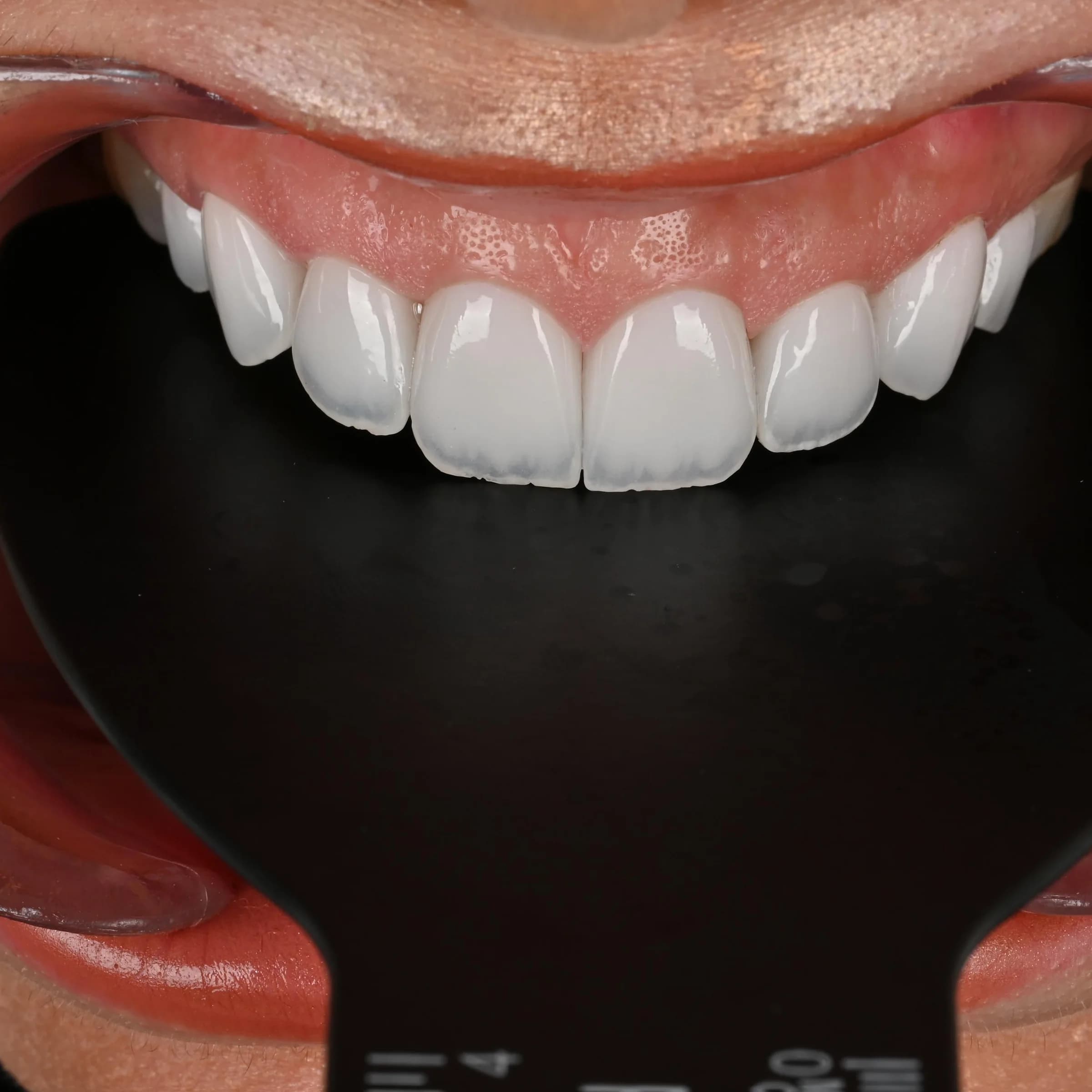 Porcelain veneers, upper and lower — photo 2