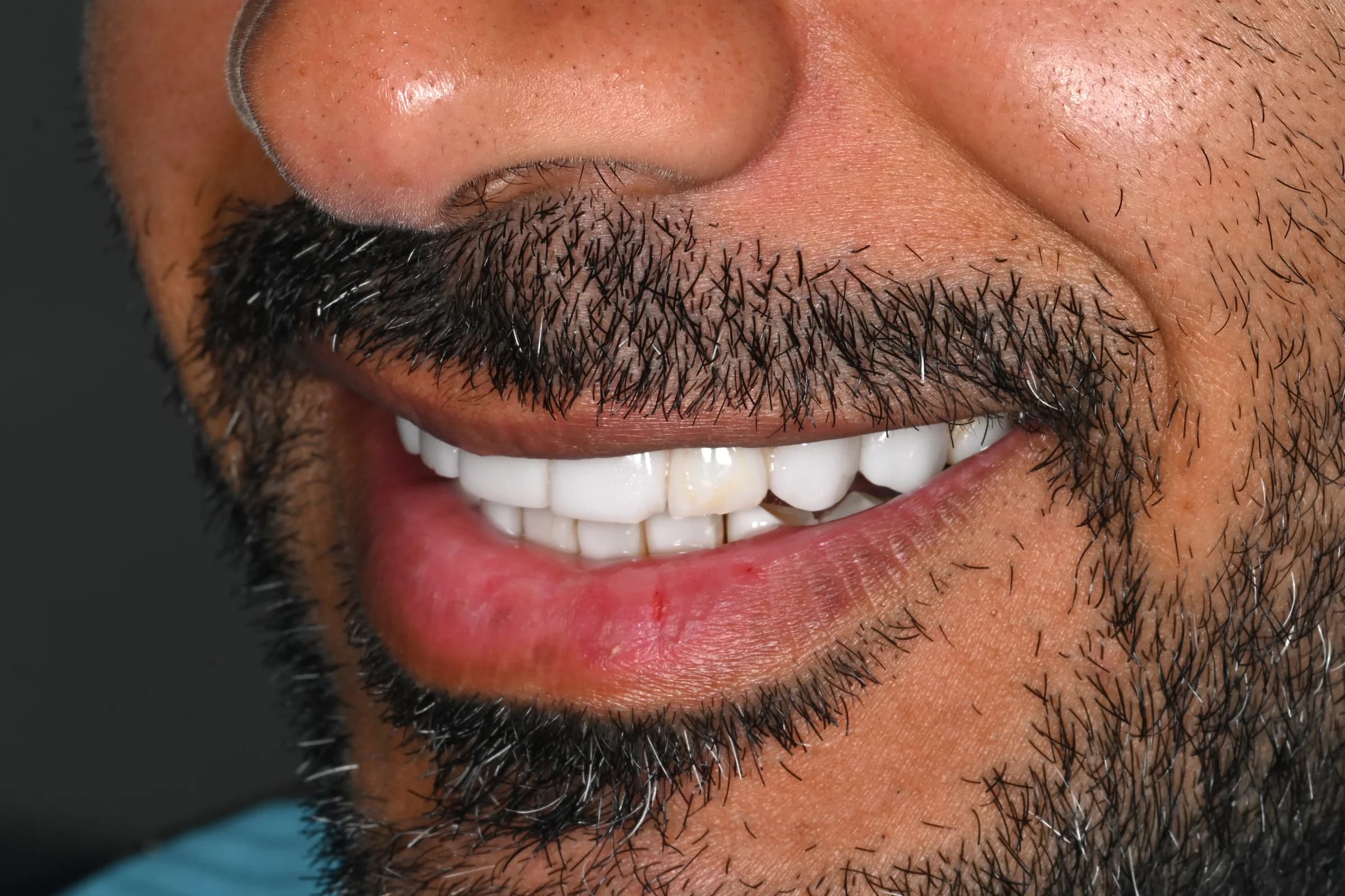 A full veneer case, six views — before treatment