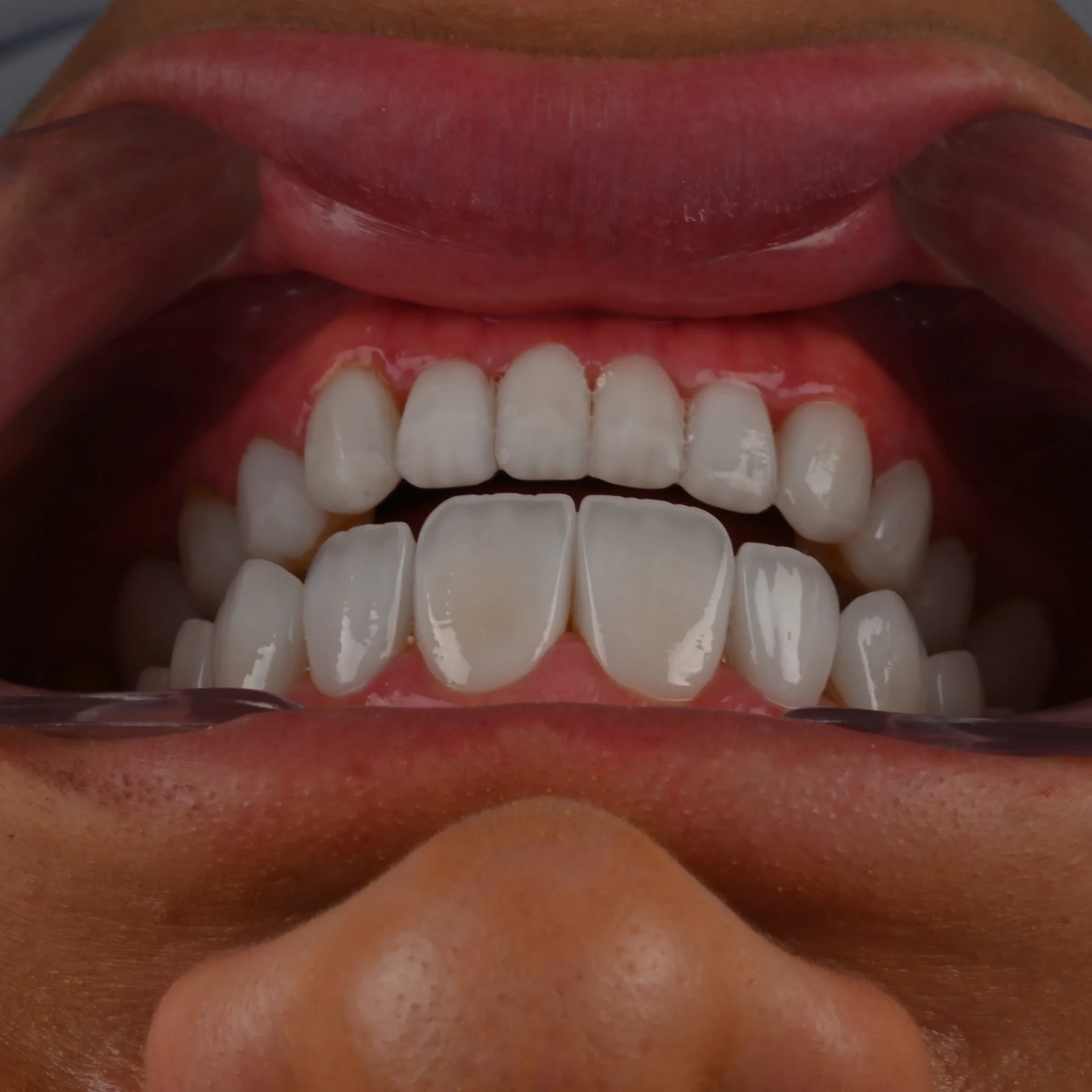 Veneers on the upper front teeth — photo 2