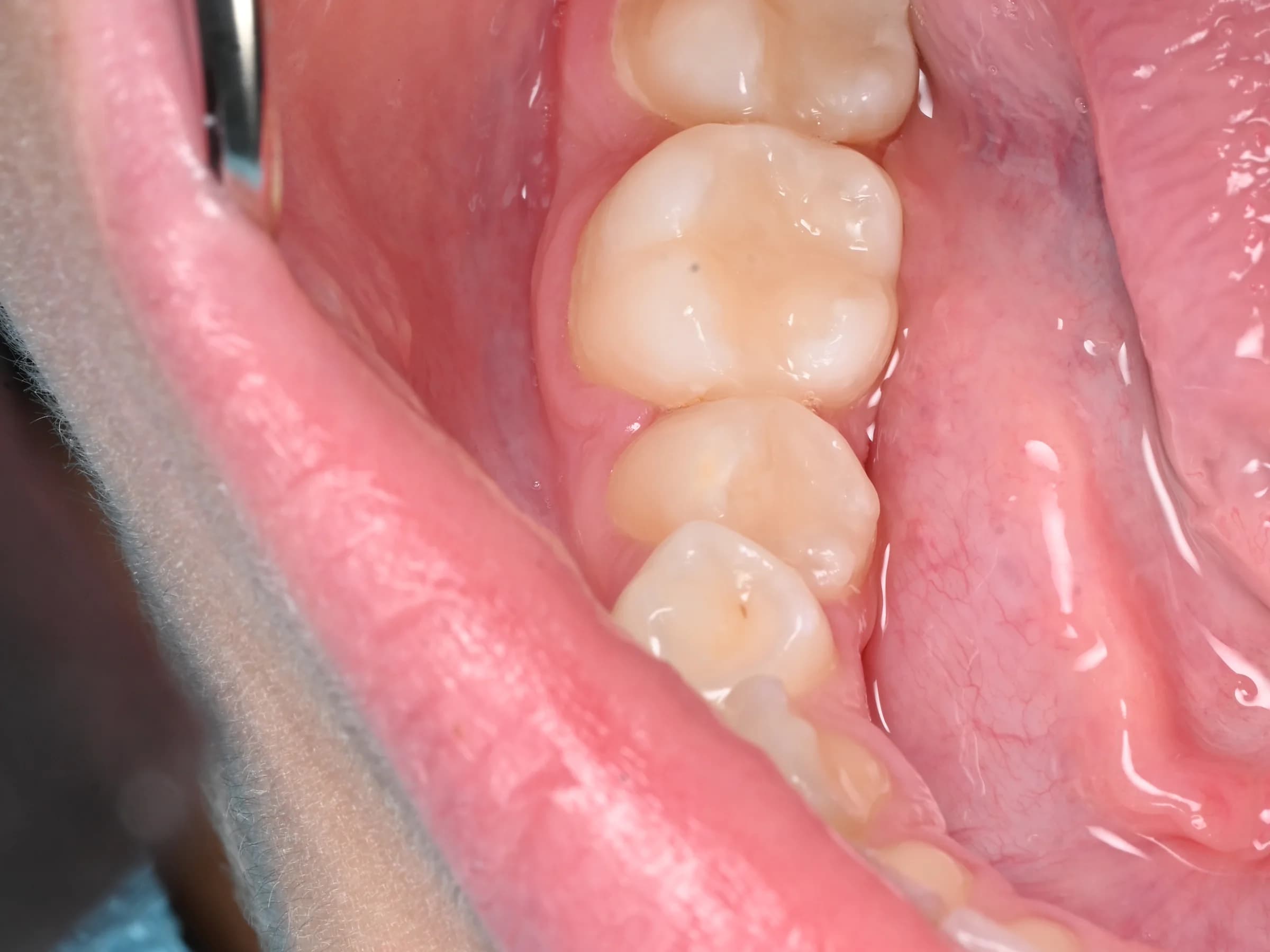 Catching decay before it spreads — after treatment