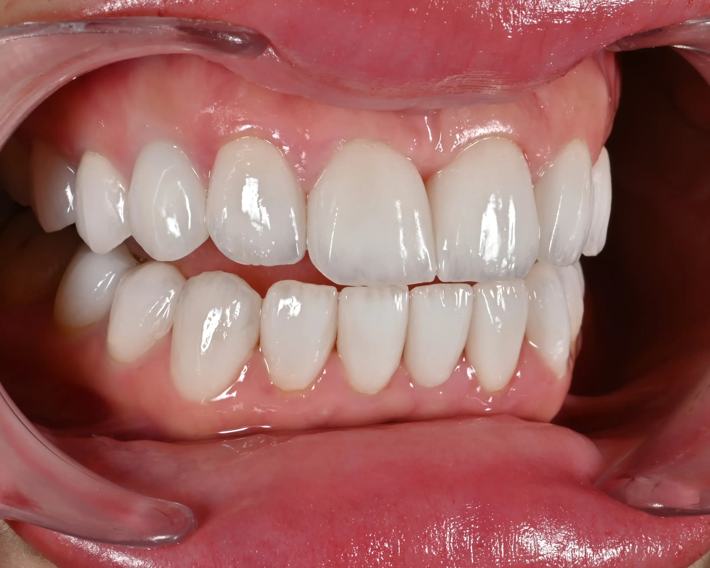 Replacing older veneers and crowns — after treatment