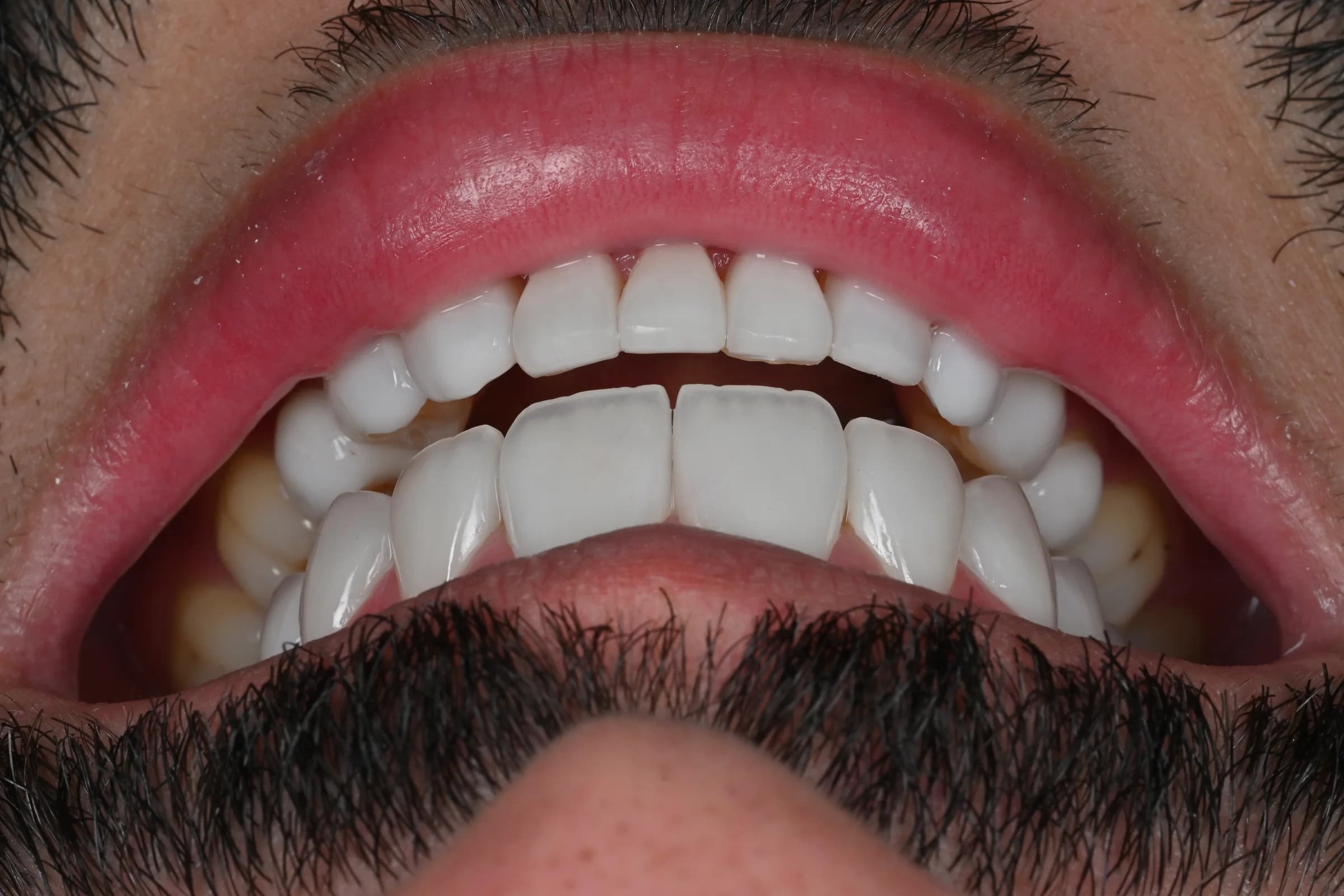 Rebuilding worn and uneven edges — after treatment