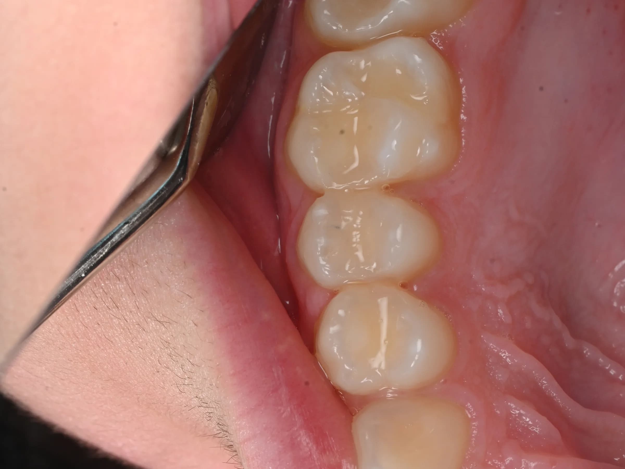 Repairing a back tooth without metal — after treatment