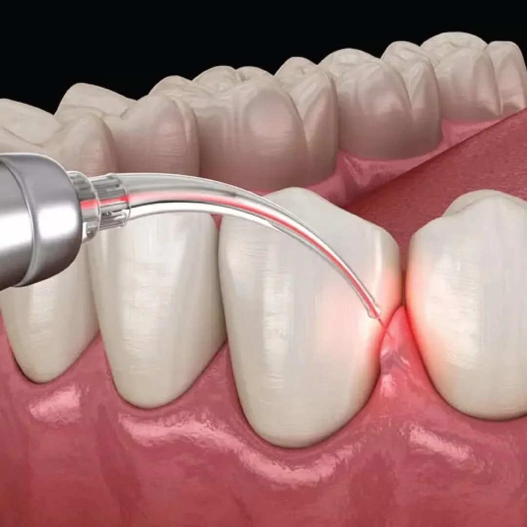Laser gum contouring