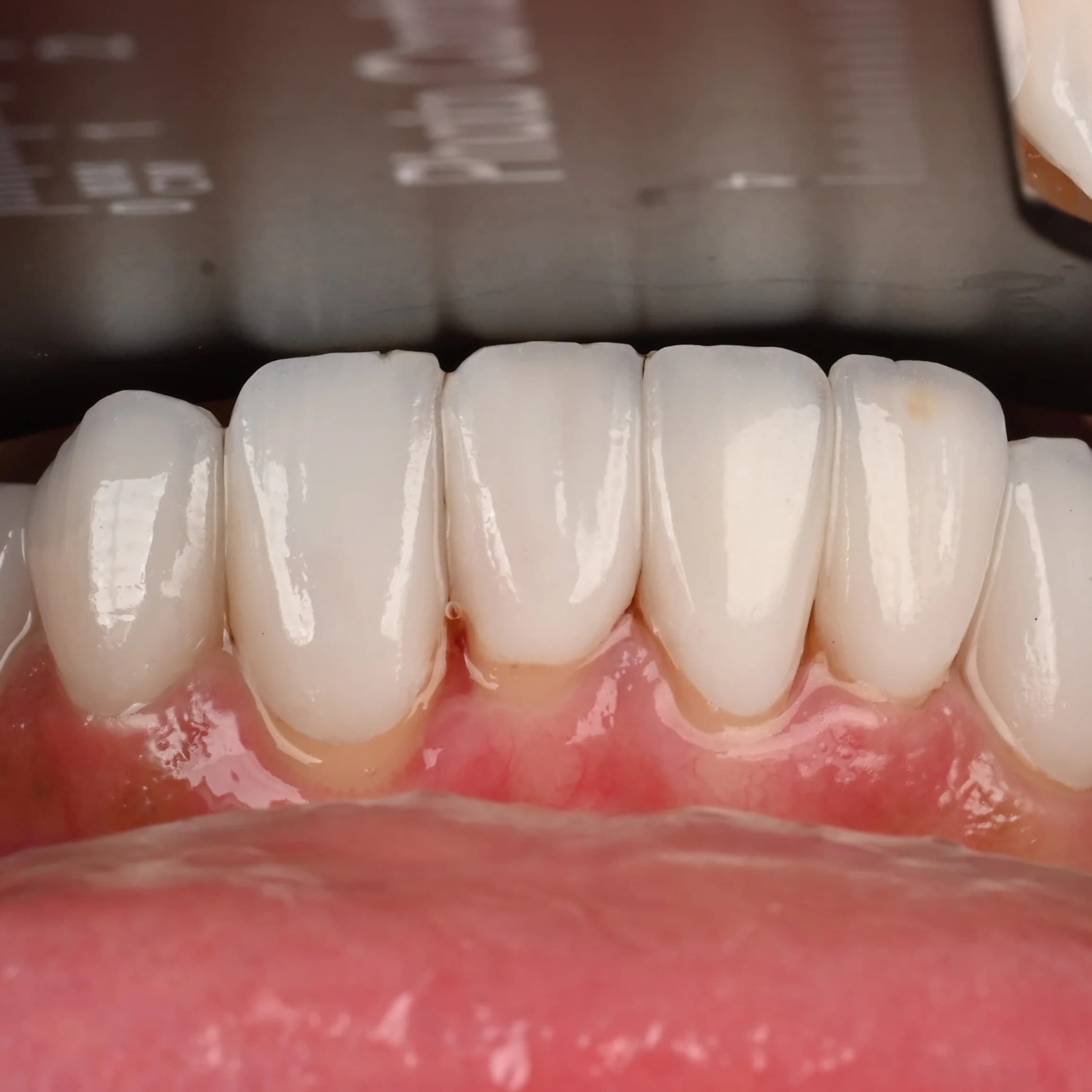 Veneers documented across five views — photo 2
