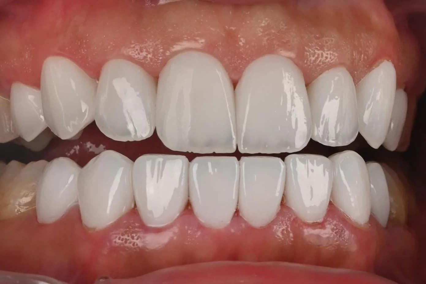 Porcelain veneers, upper and lower — after treatment