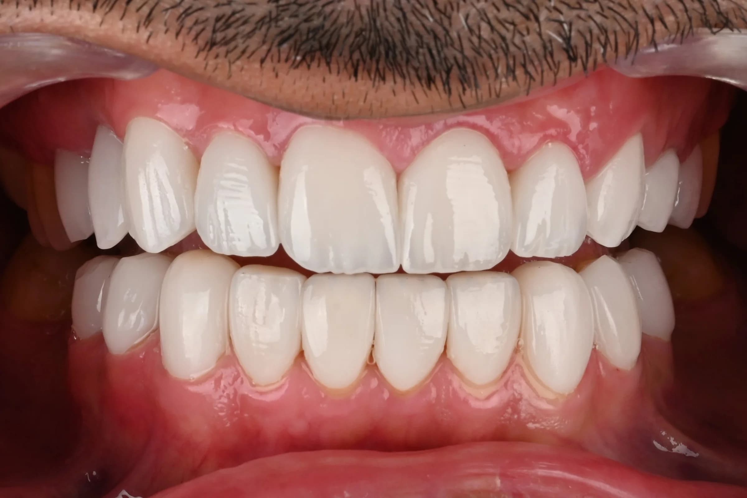 A full veneer case, six views — after treatment