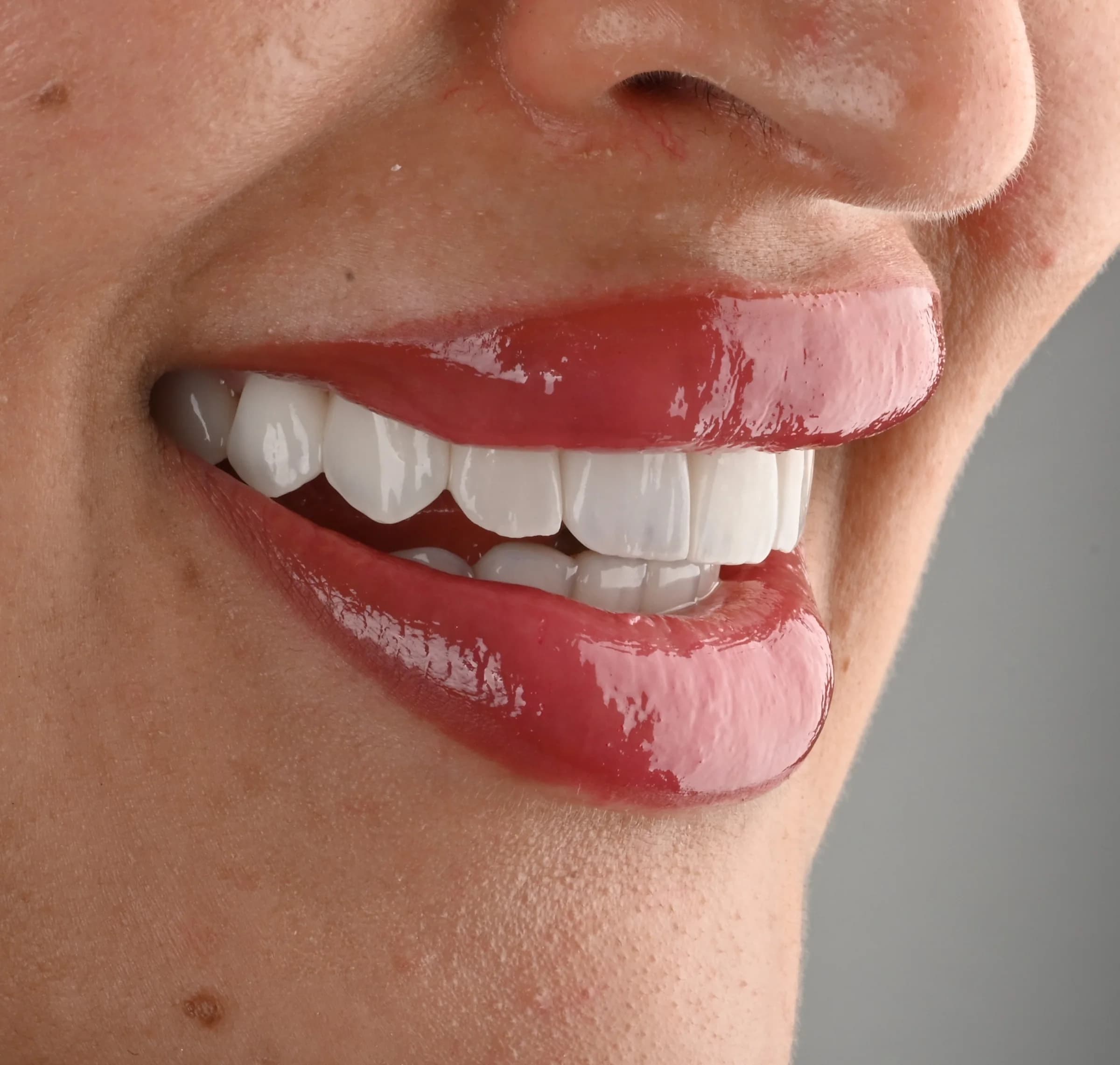 Veneers documented across five views — after treatment