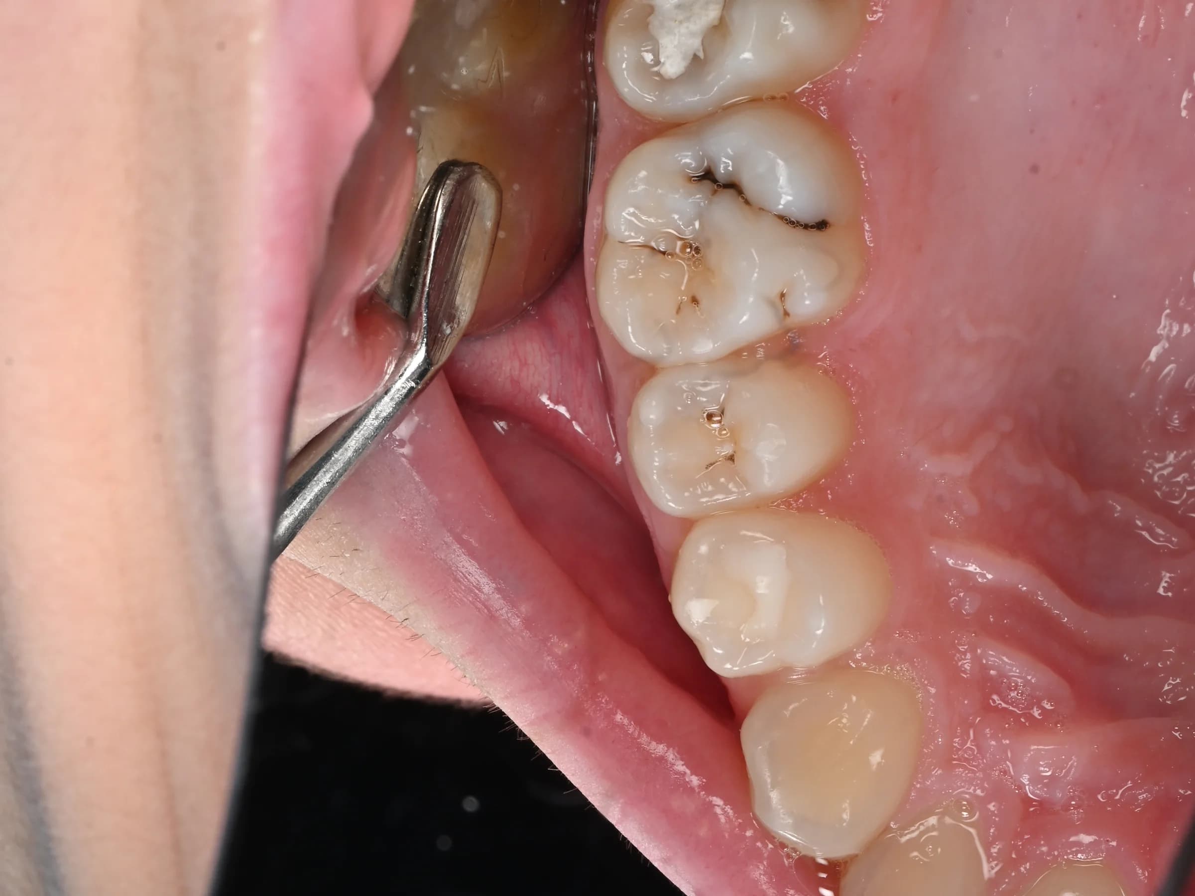 Catching decay before it spreads — before treatment