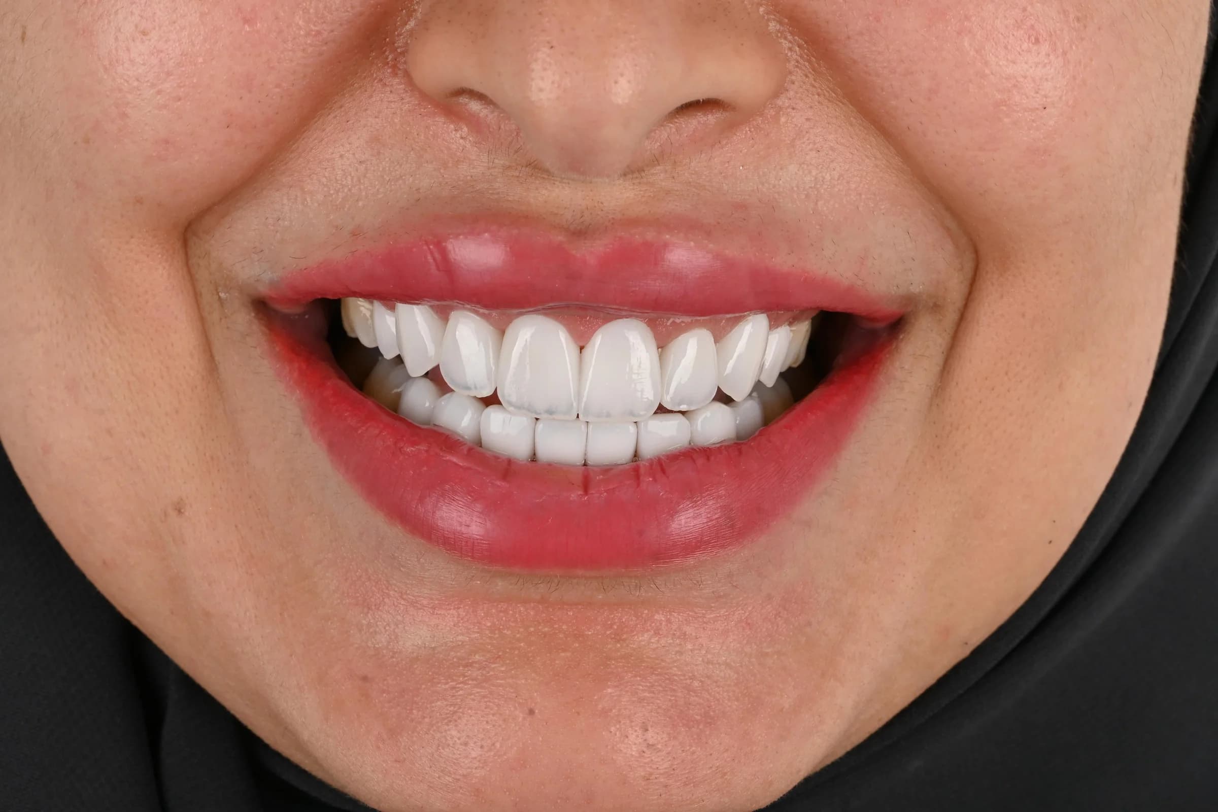 Porcelain veneers, upper and lower — after treatment