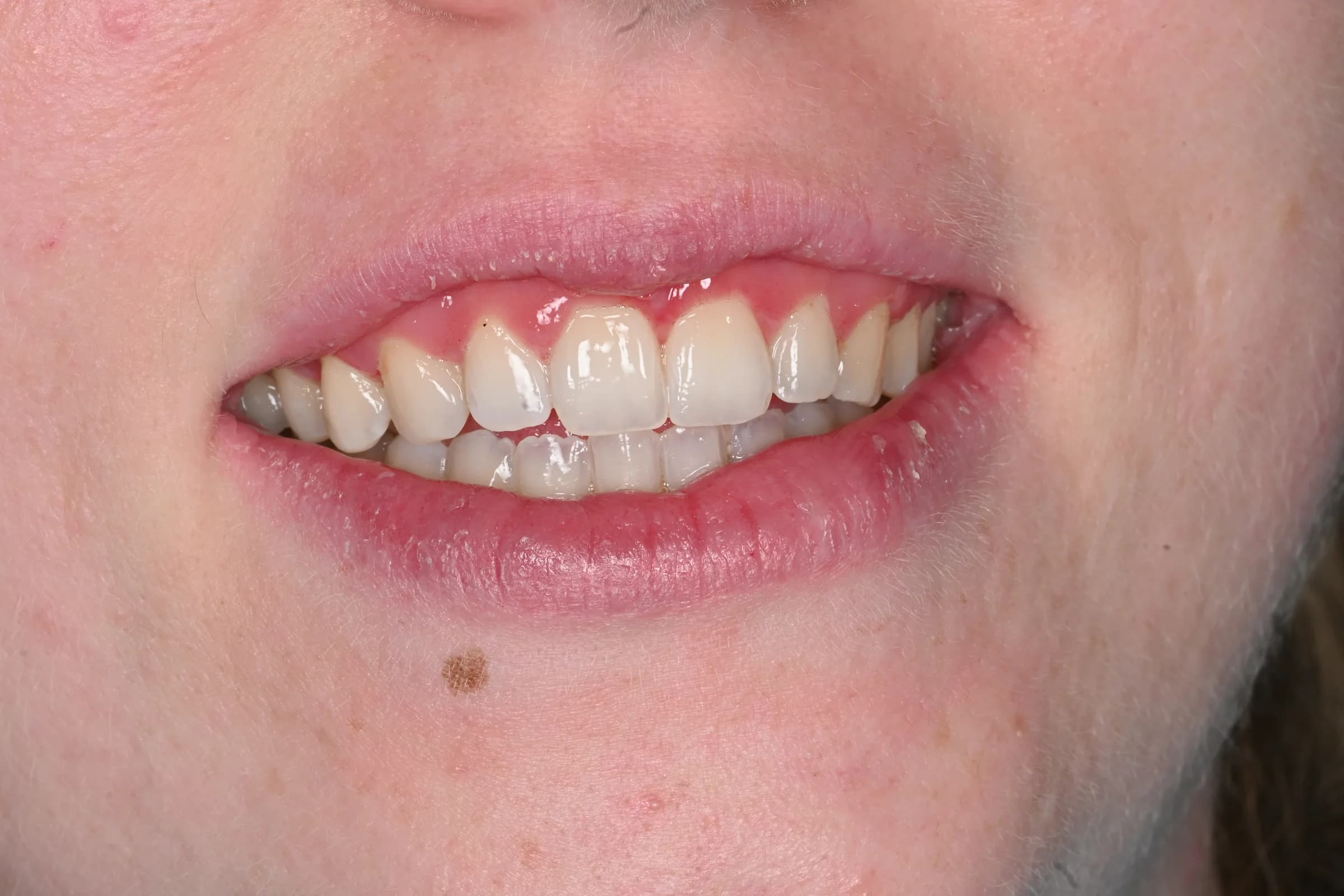 Reshaping a gummy smile — after treatment