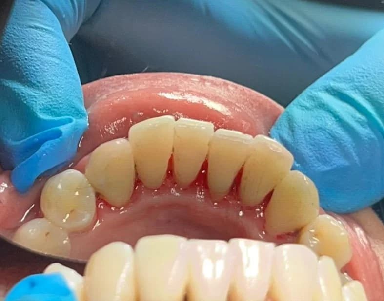 Scale and polish: removing hardened build-up — after treatment